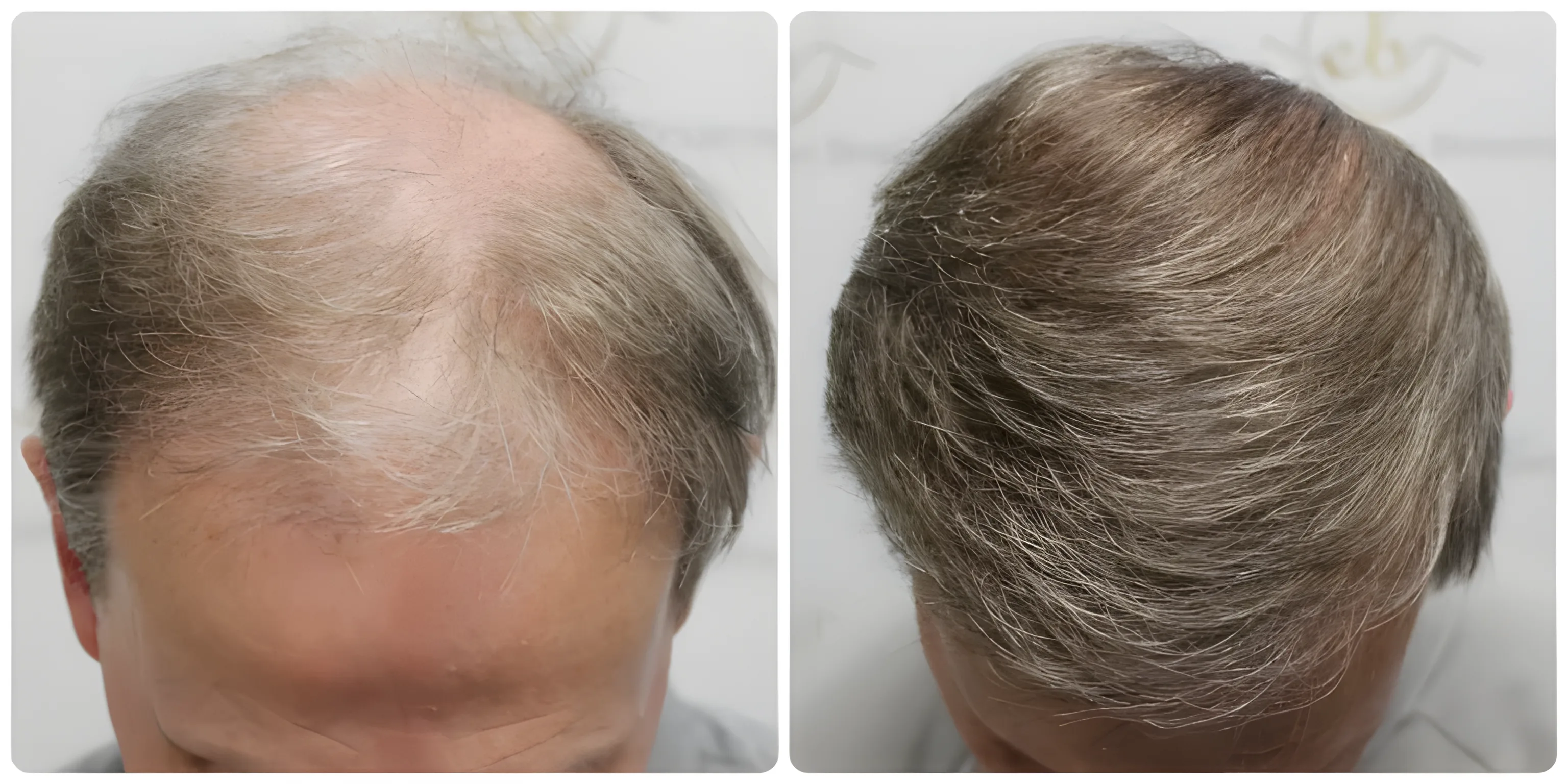 FUE hairline & crown — 3,700 grafts (two sessions)