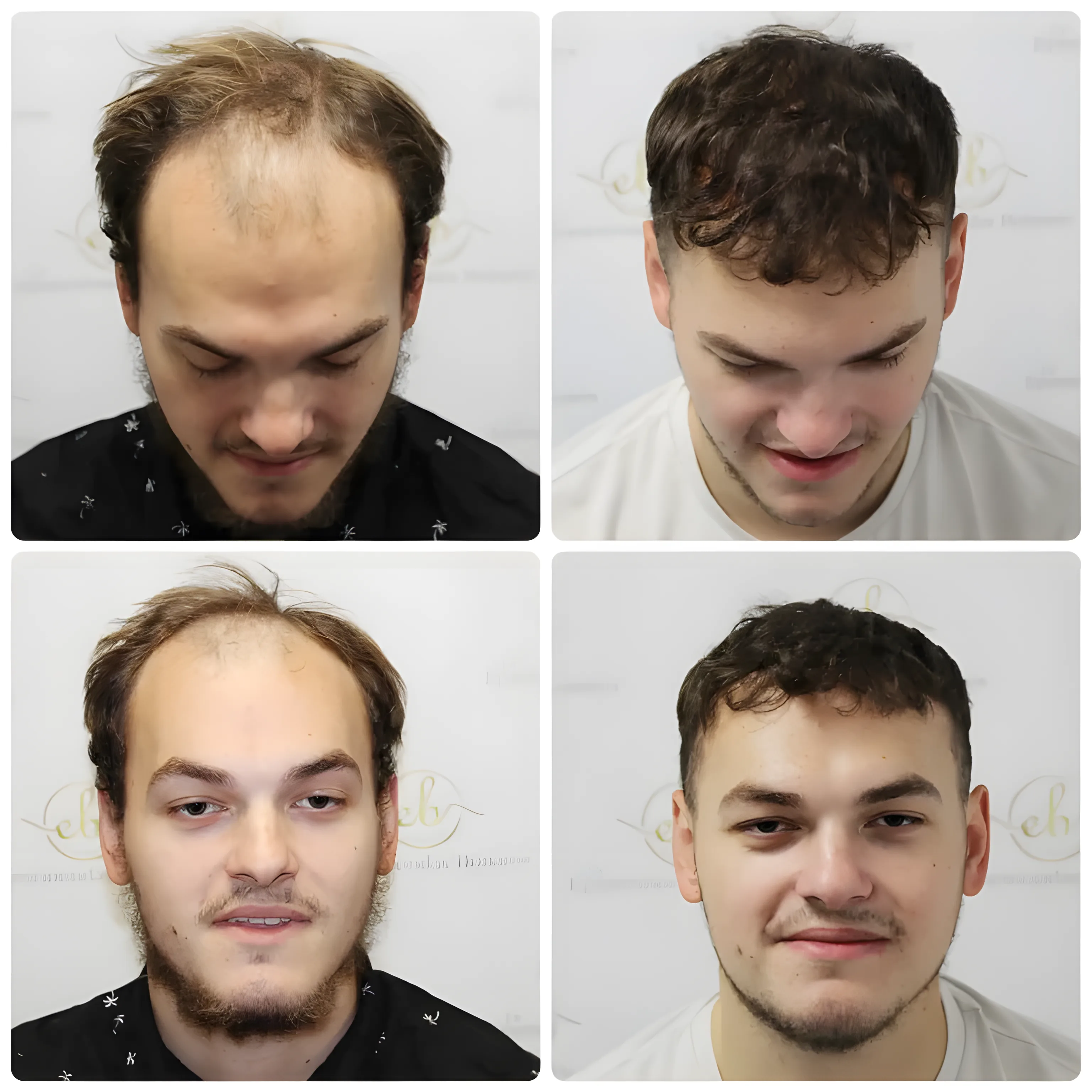 FUE receding hairline — 2,003 grafts / 4,390 hairs