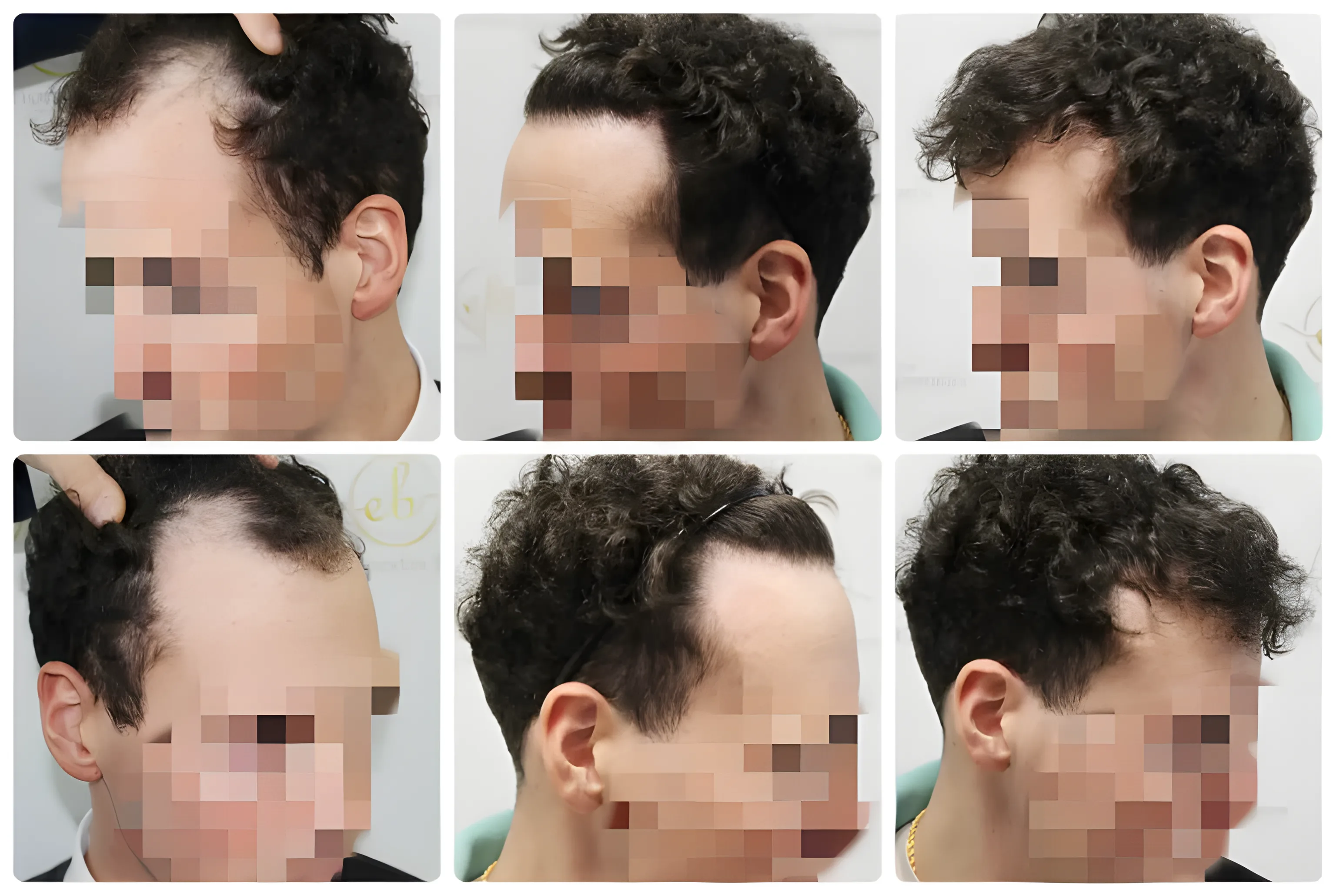 FUE hairline transplant — 2,050 grafts