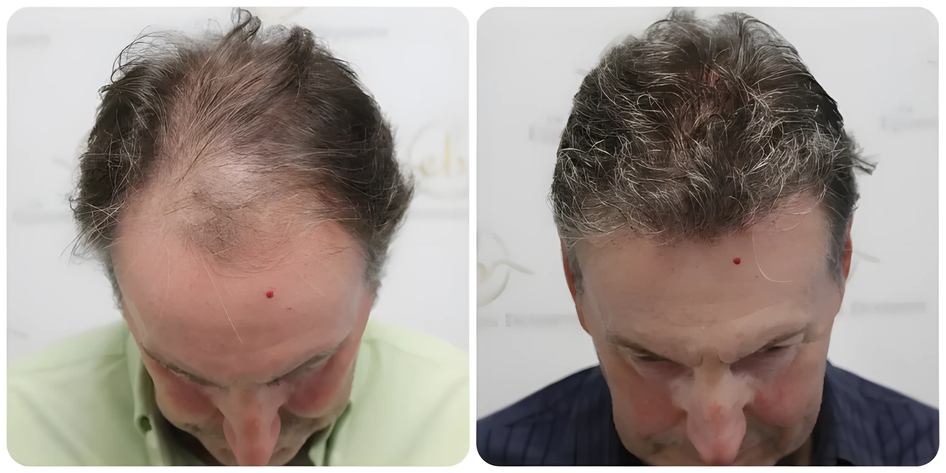 FUE hairline & crown — 3,500 grafts / 7,843 hairs