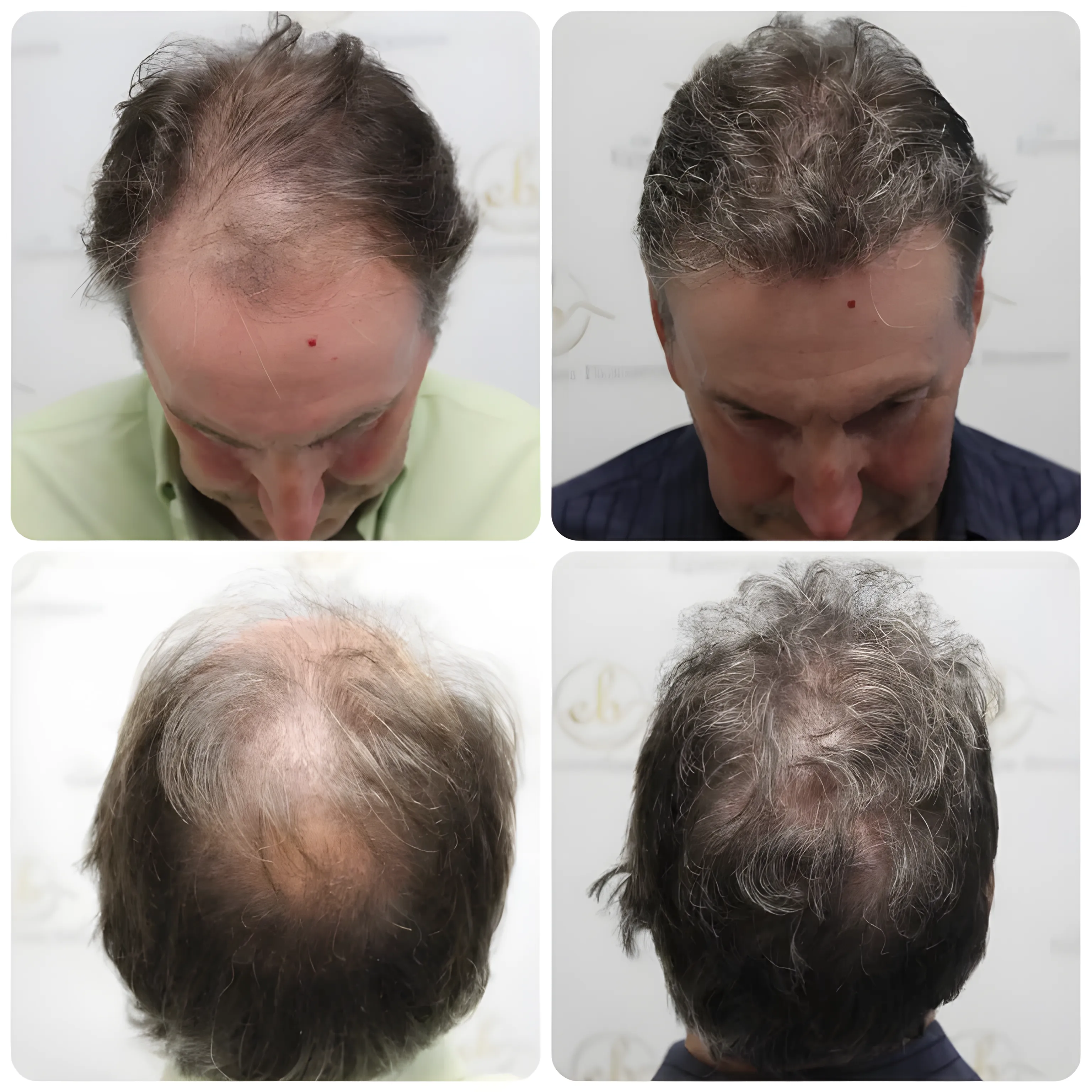 FUE hairline & crown — 3,413 grafts / 7,515 hairs