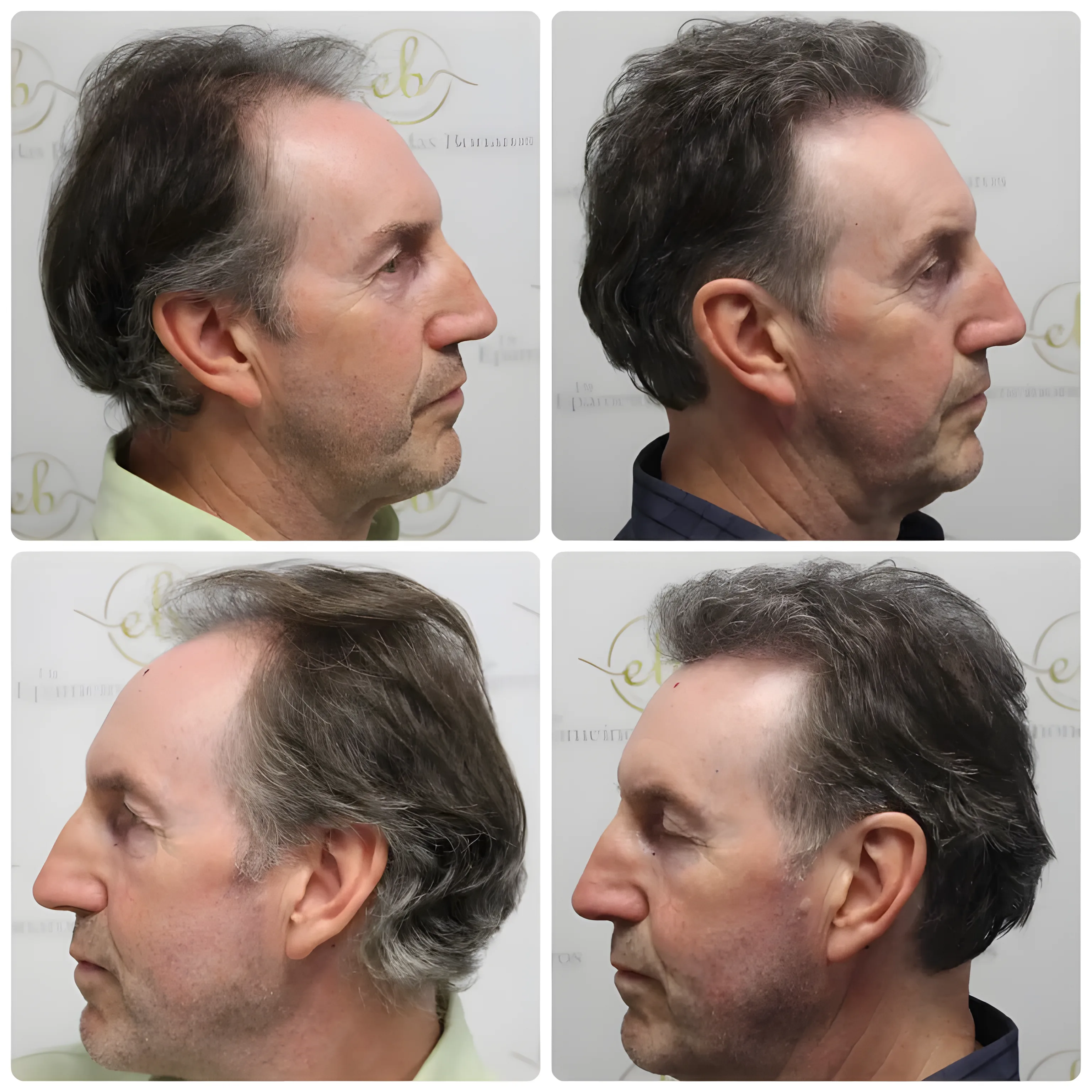 FUE hairline & crown — 3,500 grafts / 7,843 hairs