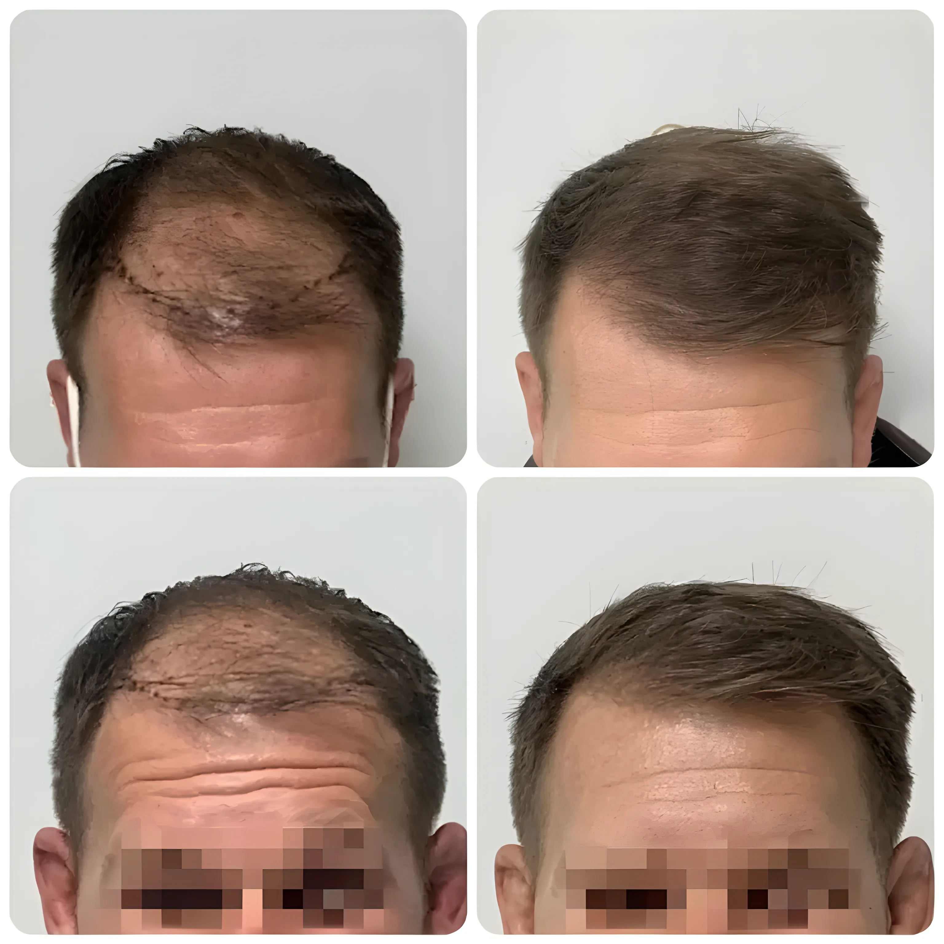 FUE hairline transplant — 2,000 grafts