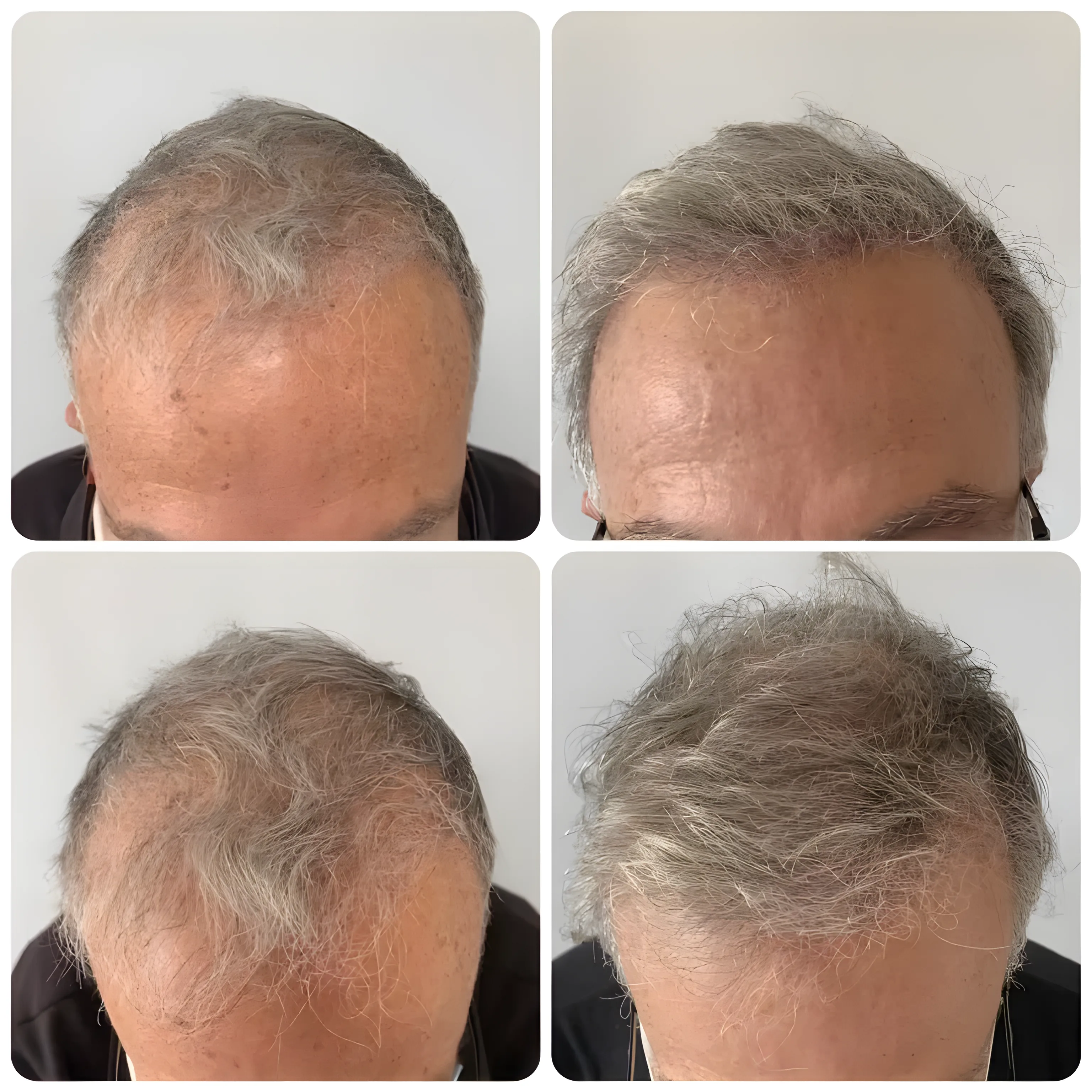 FUE frontal scalp — 1,300 grafts / 2,600 hairs