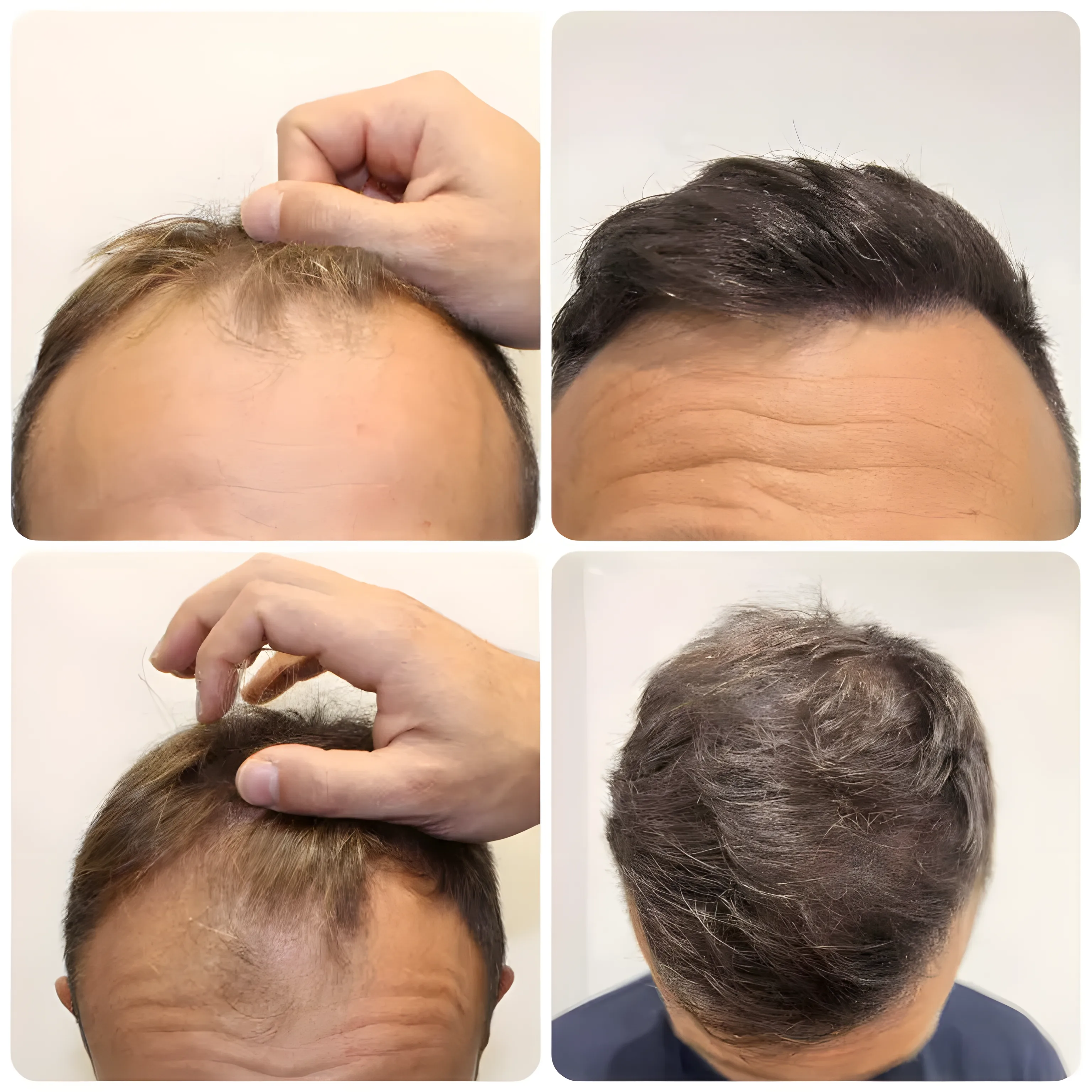 FUE receding hairline — 2,042 grafts / 4,933 hairs