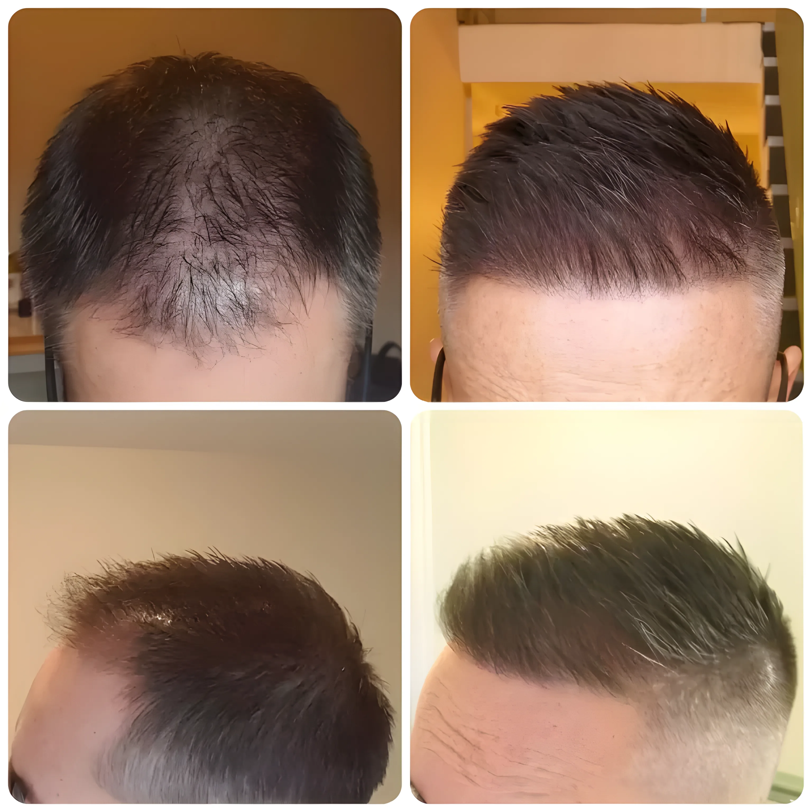 FUE hairline transplant — 1,208 grafts / 2,929 hairs