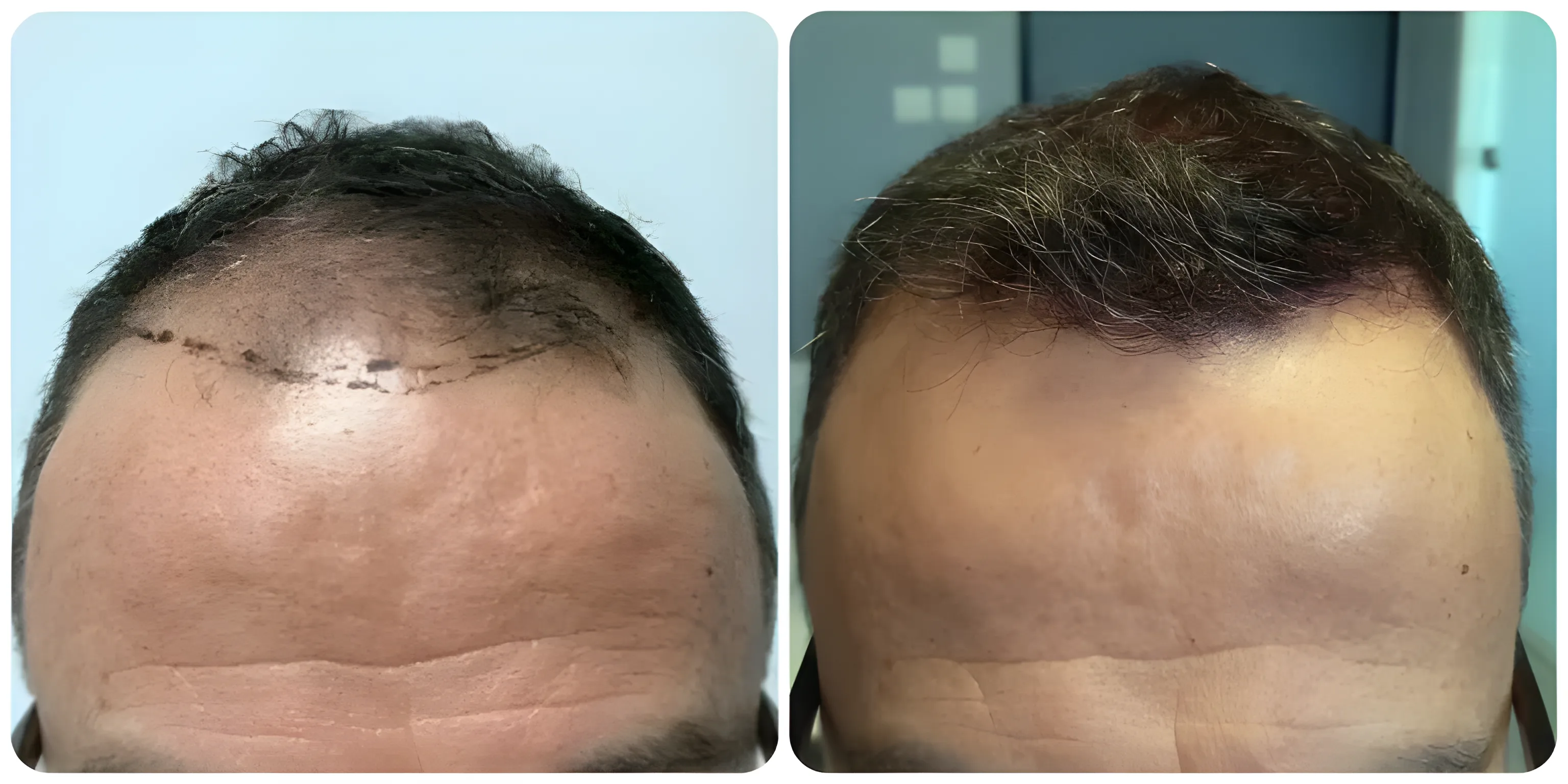 FUE frontal scalp — 1,720 grafts / 5,120 hairs