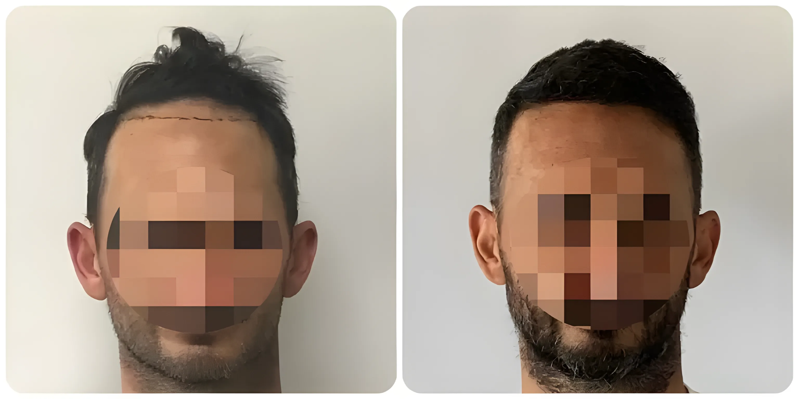 FUE hairline & frontal third — 1,649 grafts / 3,916 hairs