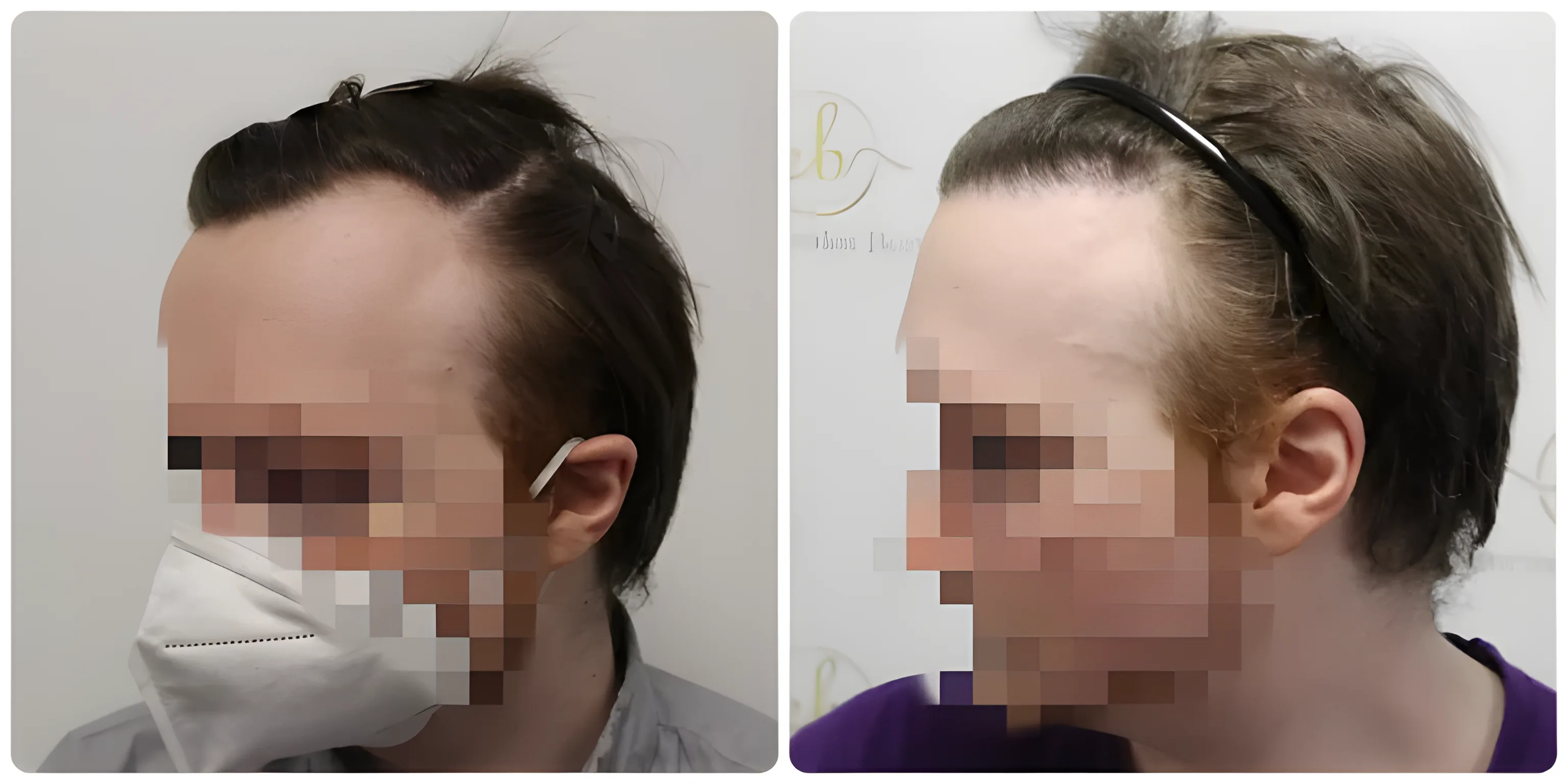 FUE receding hairline — 1,614 grafts / 3,577 hairs