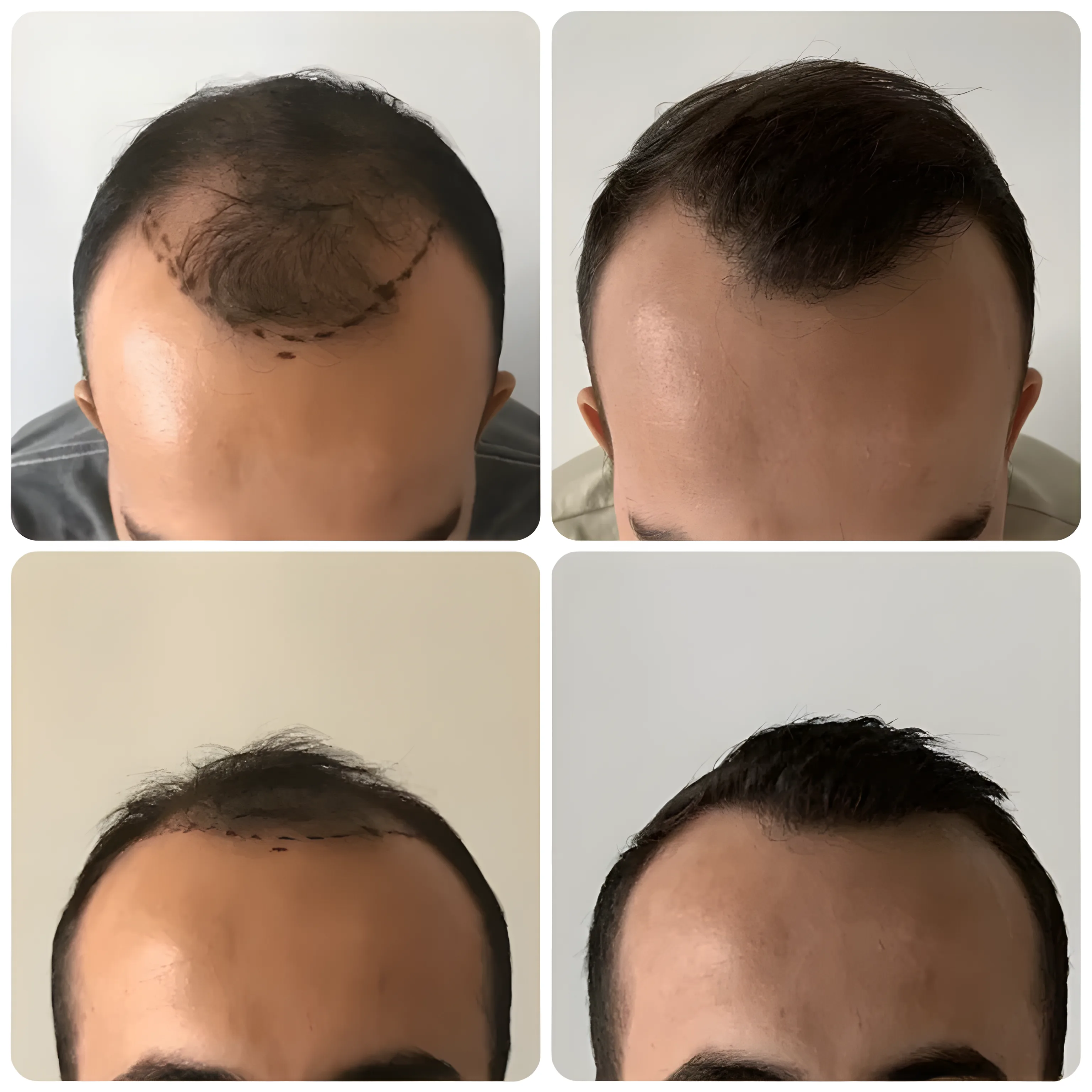 FUE mature hairline — 1,800 grafts