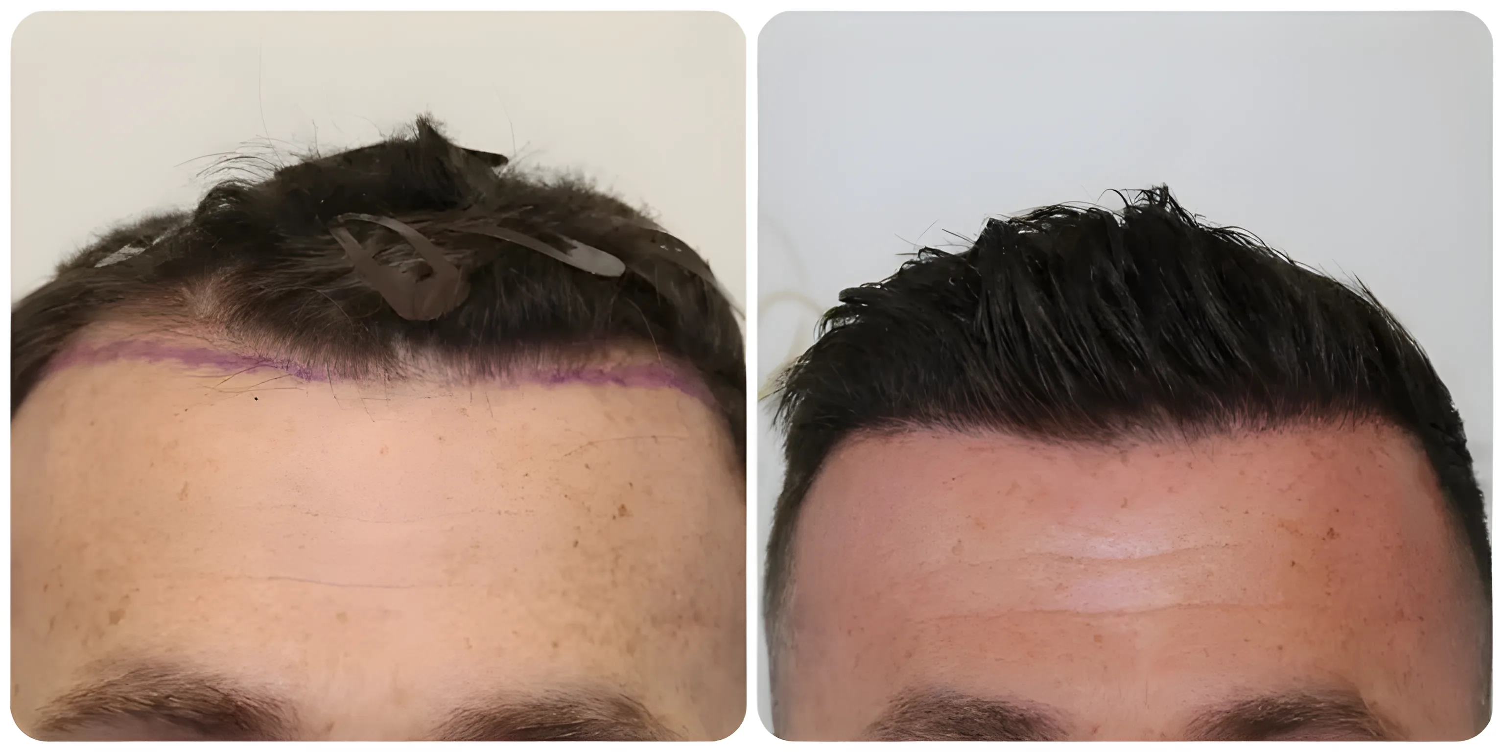FUE receding hairline — 1,456 grafts / 3,621 hairs