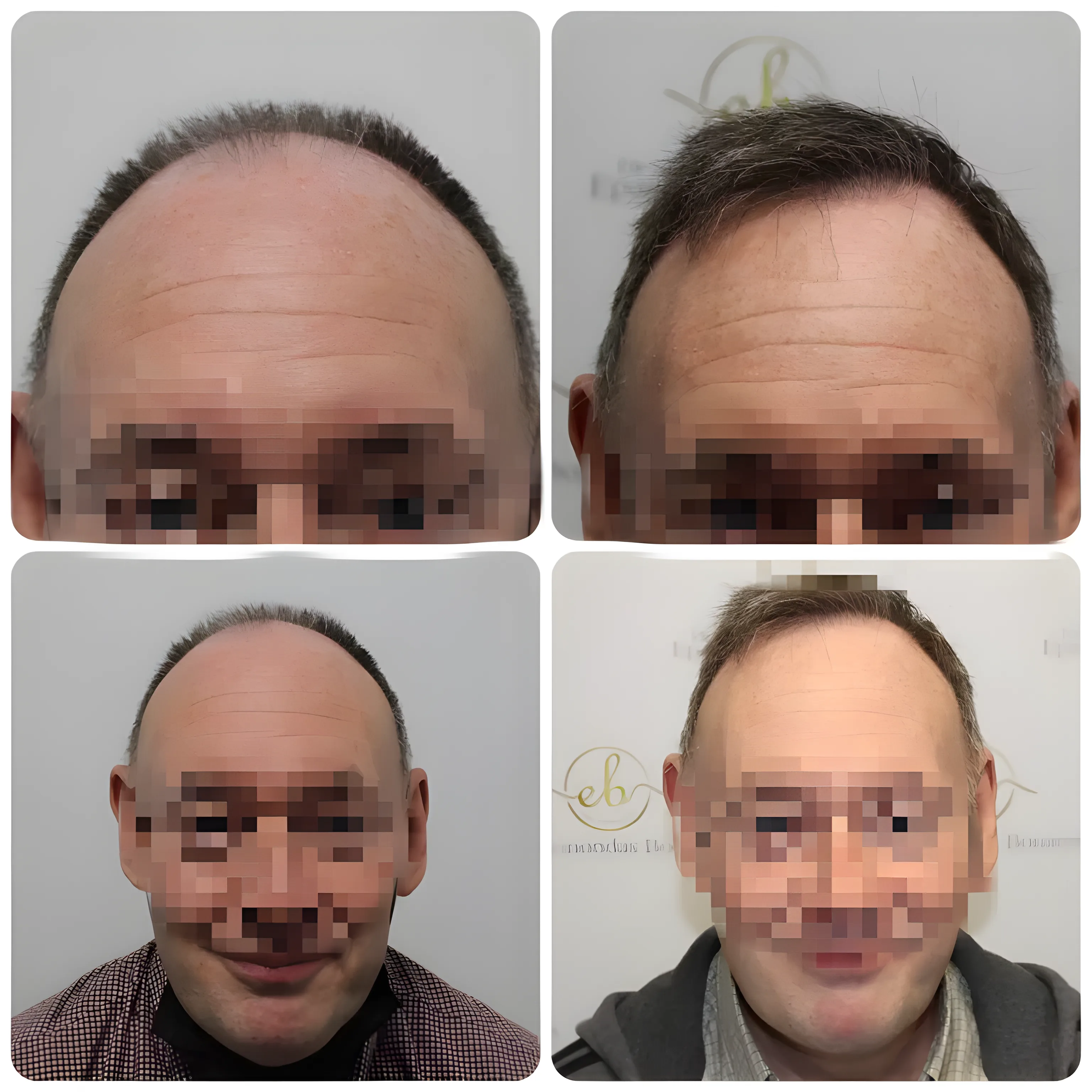 FUE hairline transplant — 1,662 grafts / 3,144 hairs