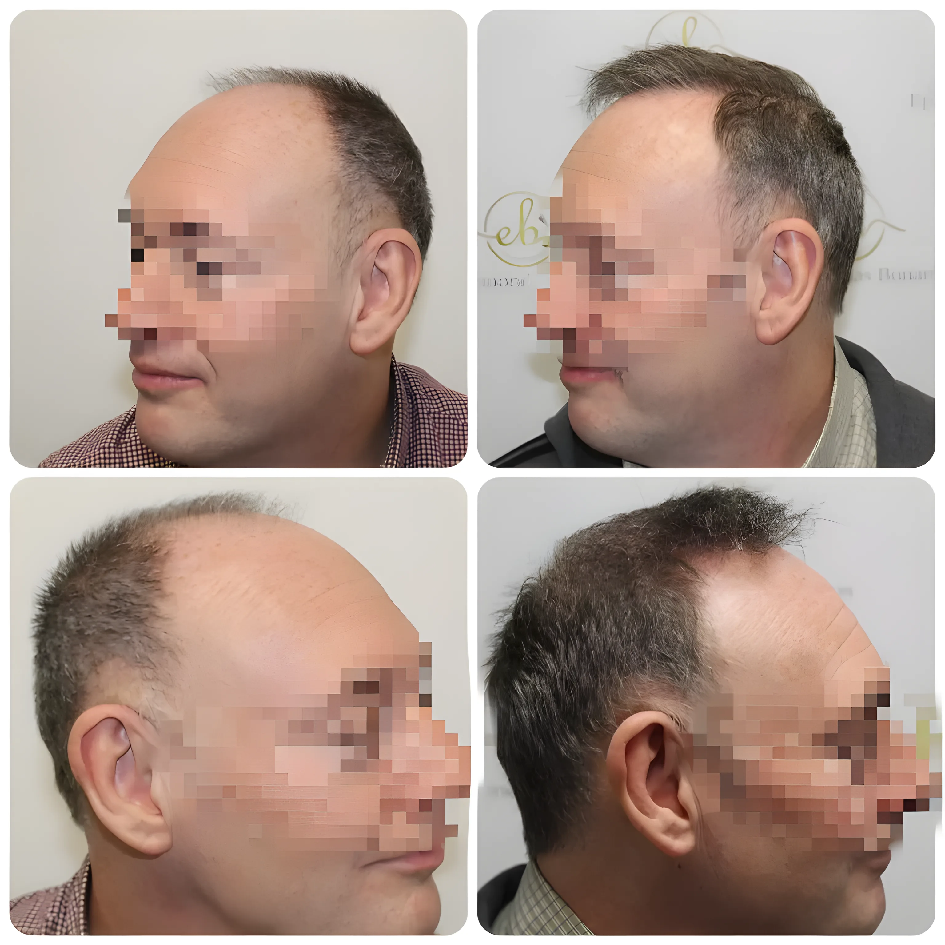 FUE hairline transplant — 1,662 grafts / 3,144 hairs