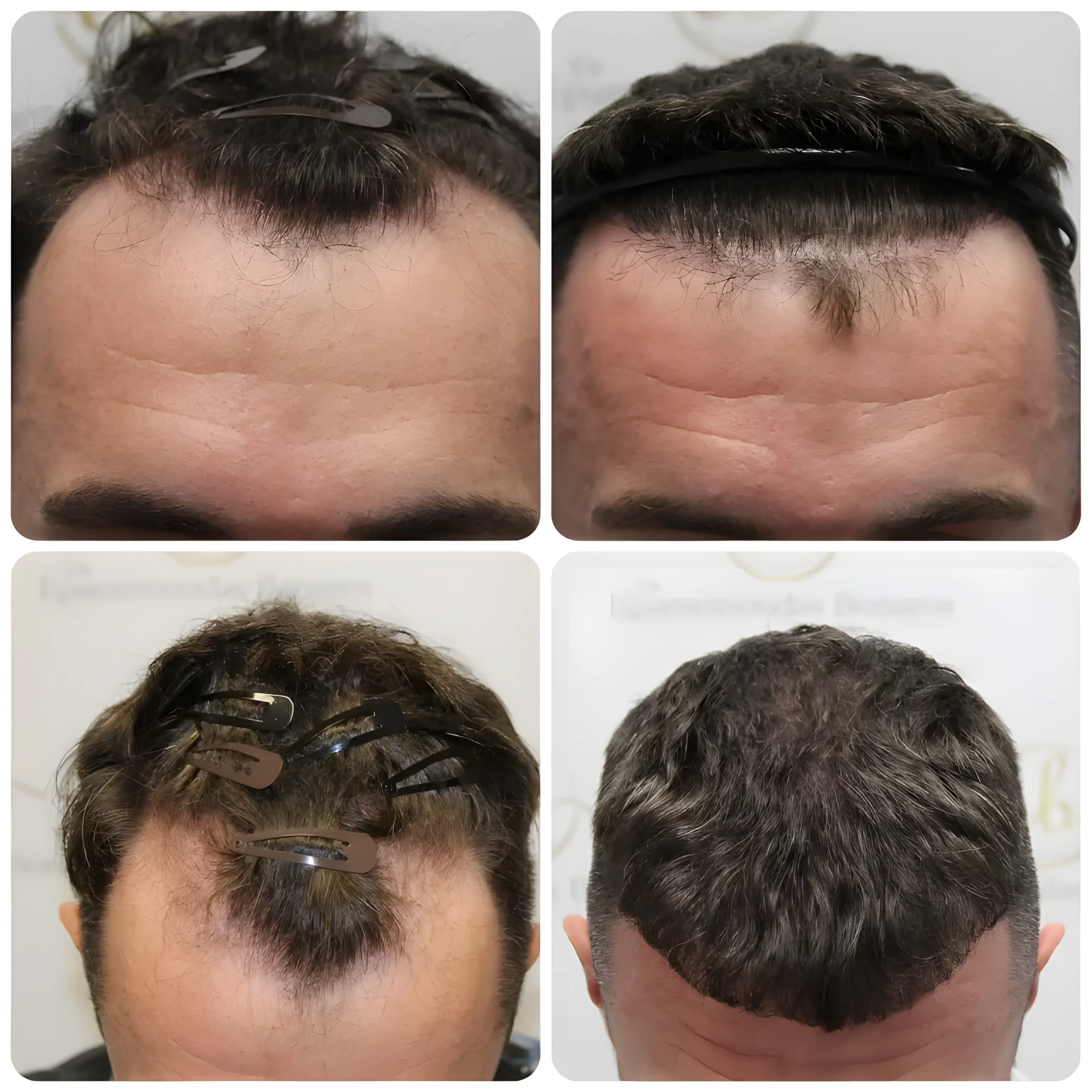 FUE hairline transplant — 2,026 grafts / 5,169 hairs