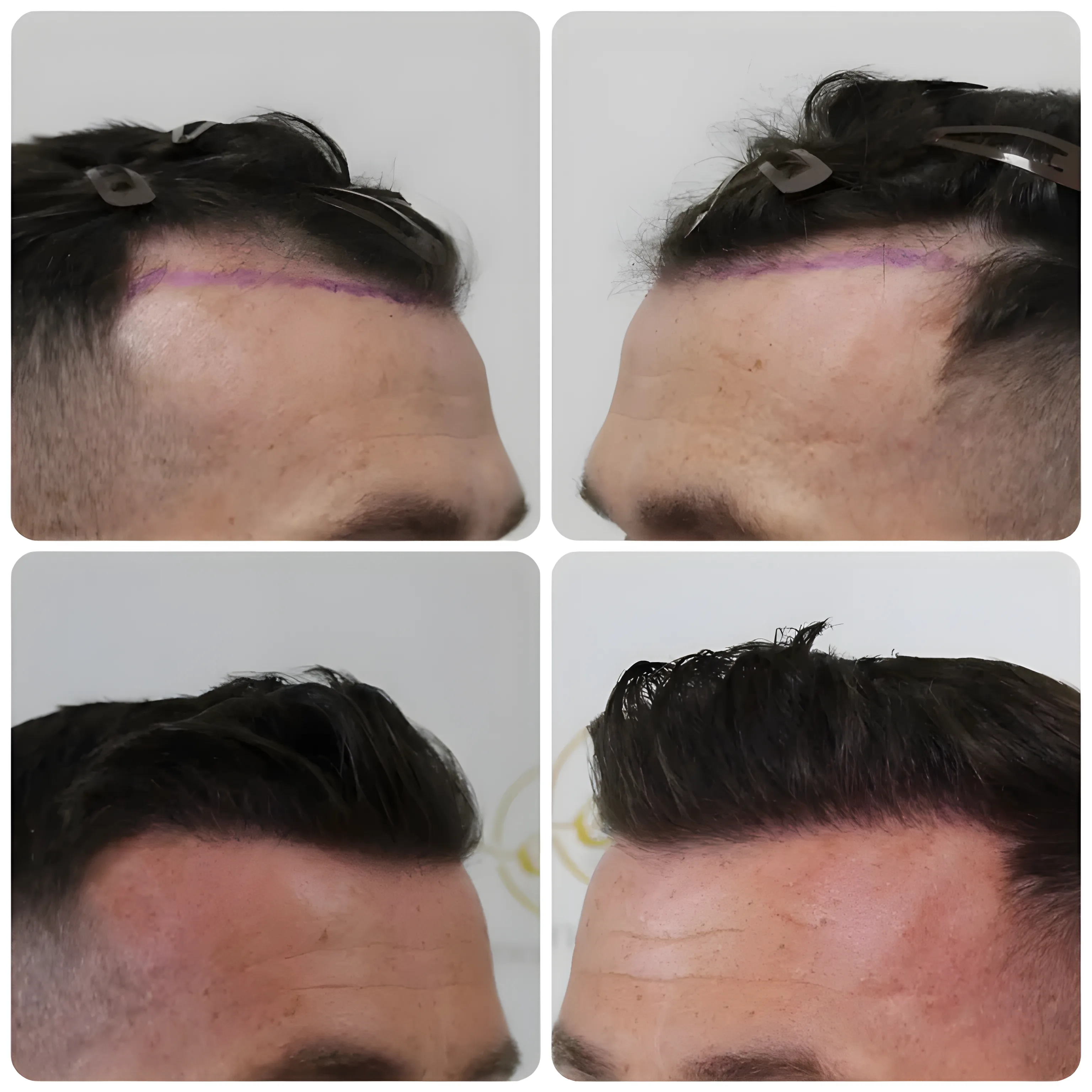 FUE receding hairline — 1,456 grafts / 3,621 hairs