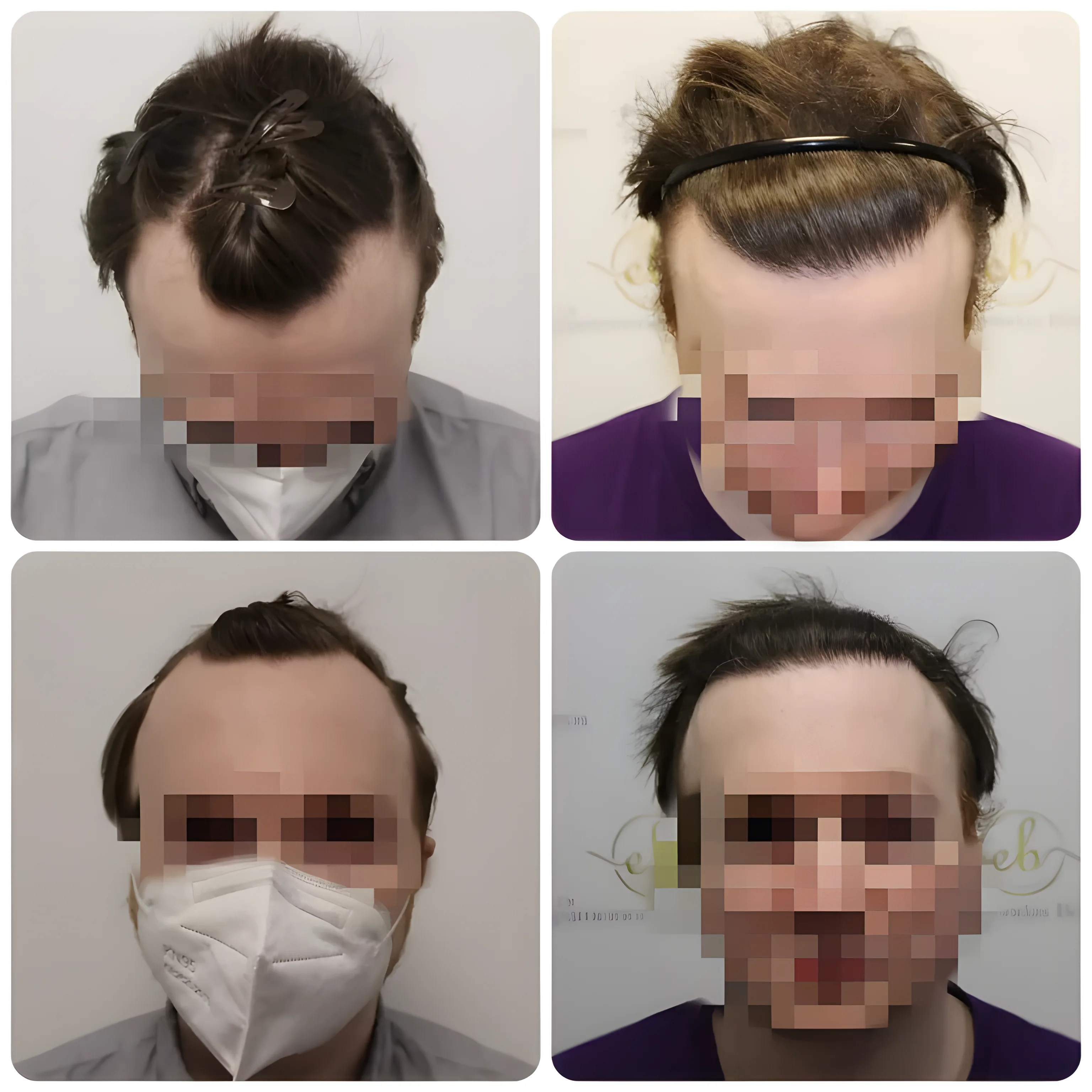 FUE receding hairline — 1,614 grafts / 3,577 hairs