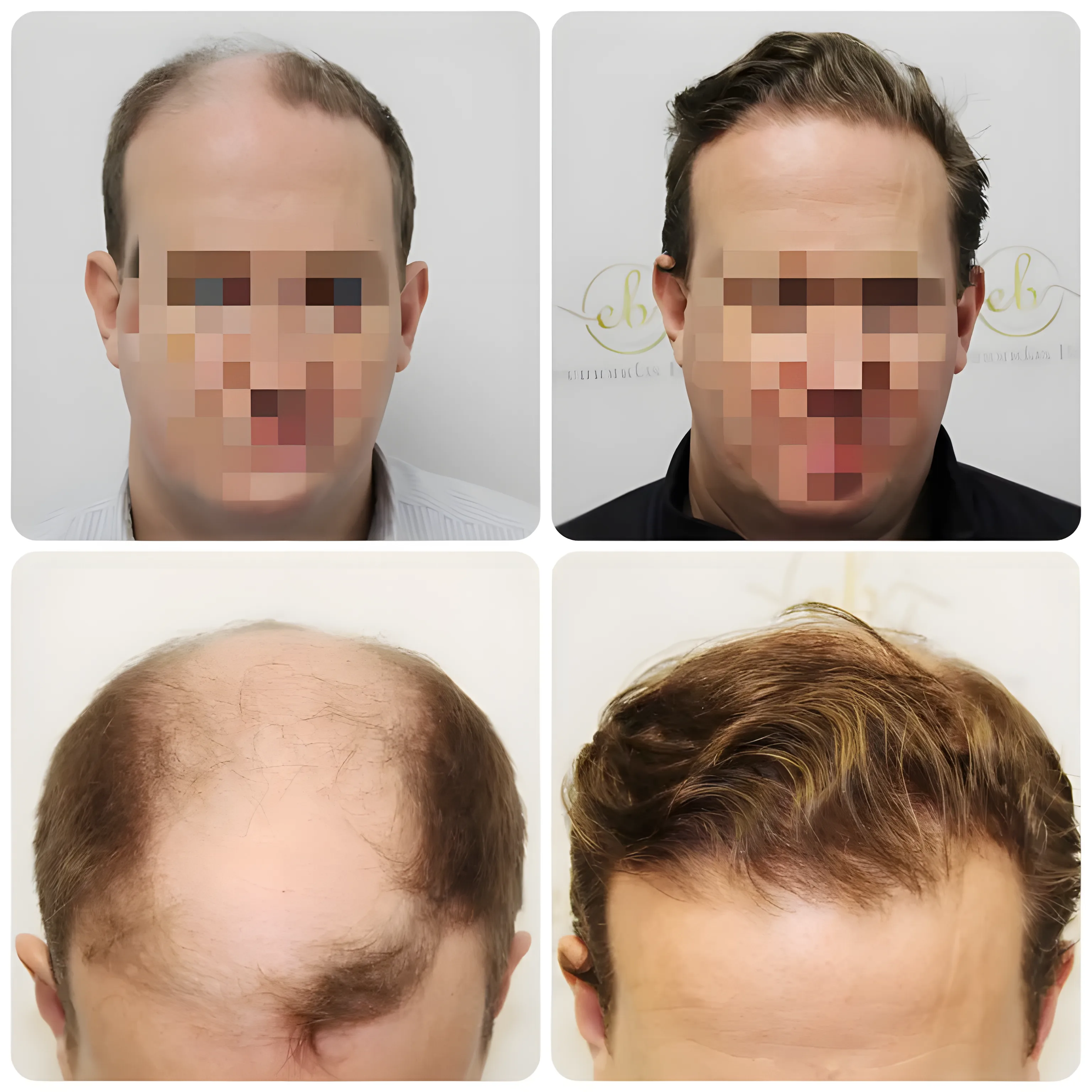 FUE frontal & mid-scalp — 4,012 grafts