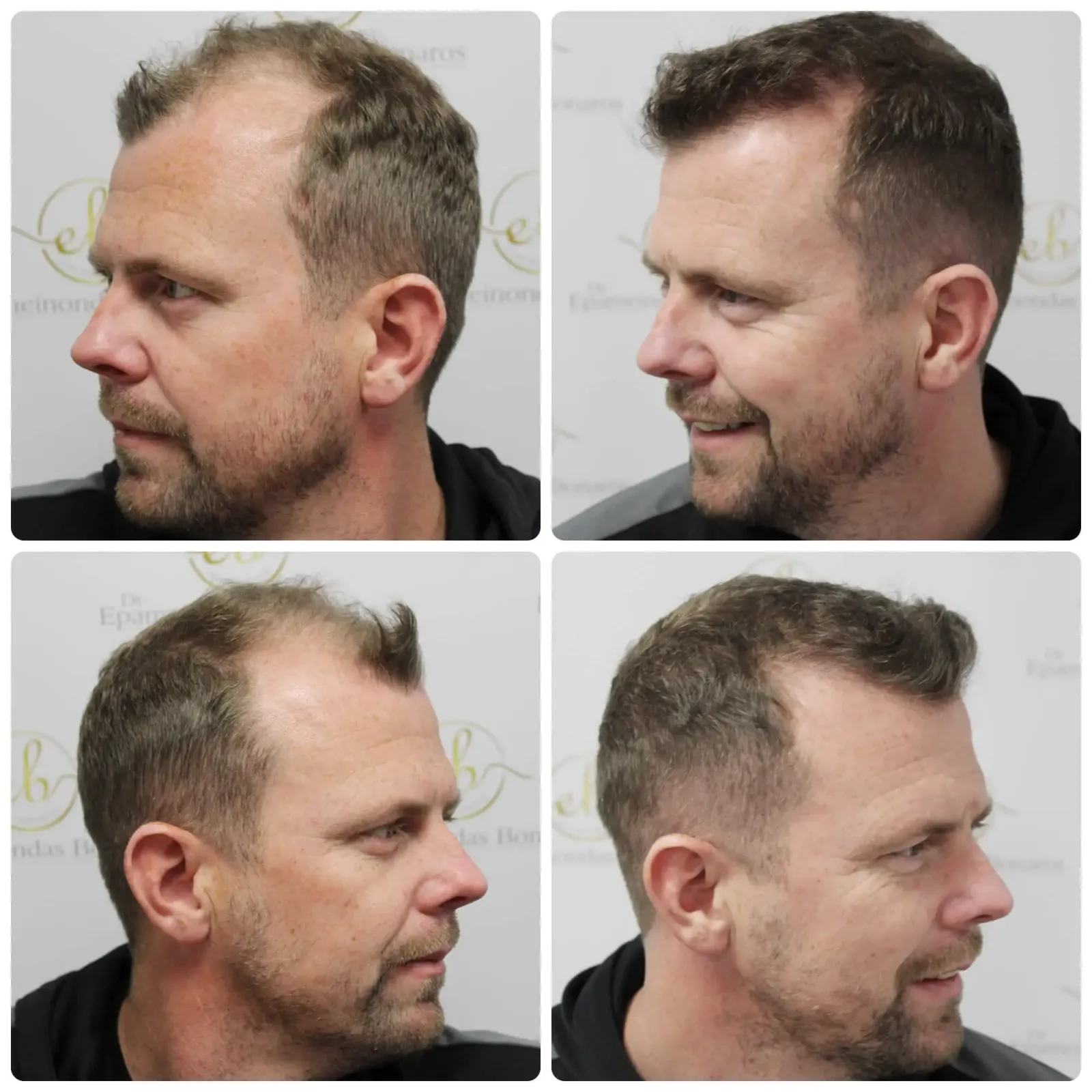 What is a hairline transplant