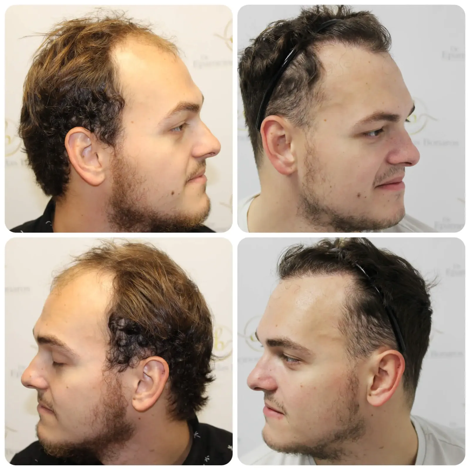 Hairline transplant questions answered