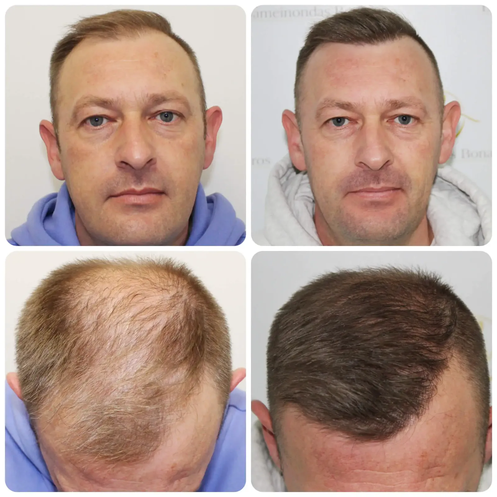 Hairline after treatment
