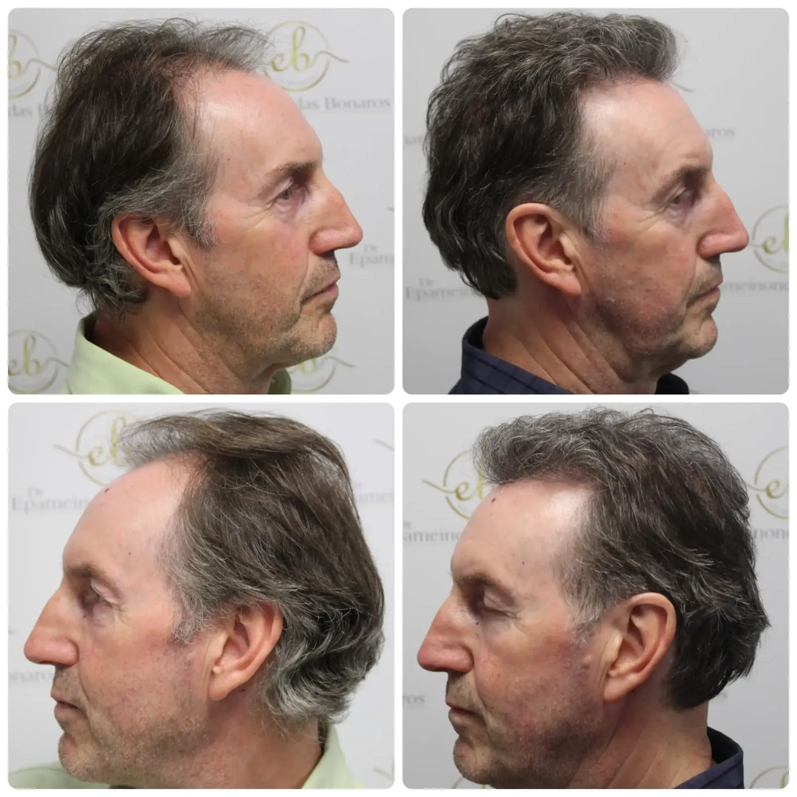 How a frontal hair transplant is done