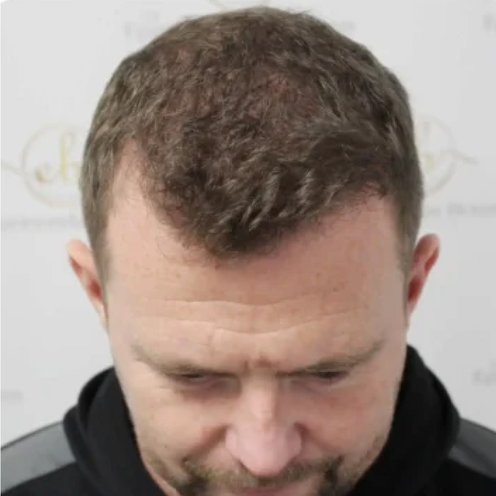 After hair restoration