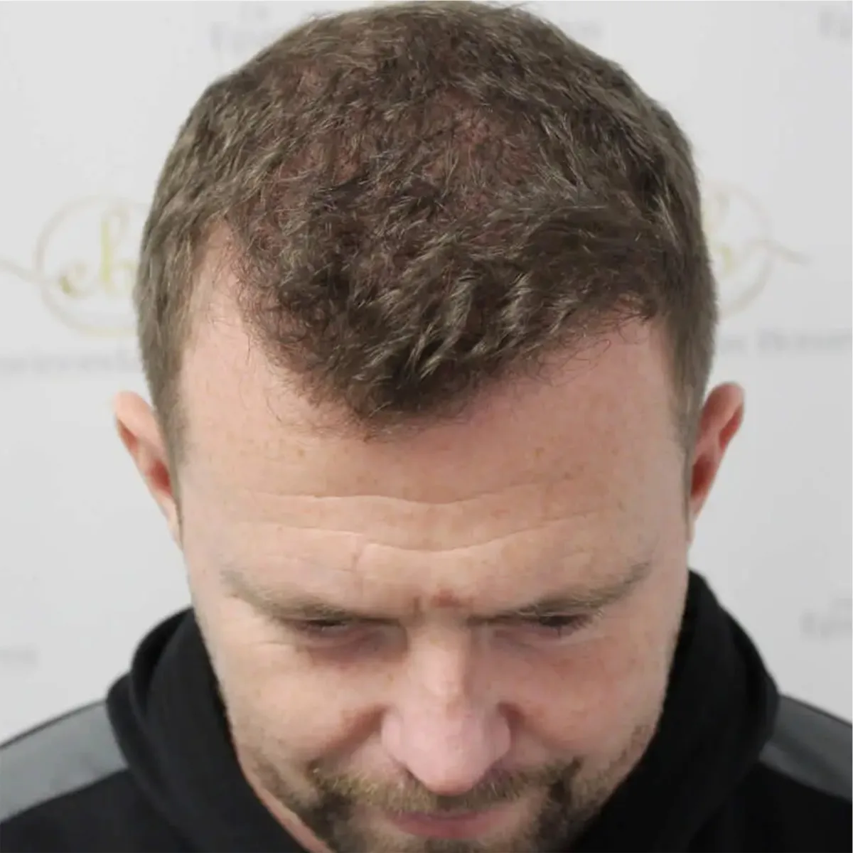 After hair restoration