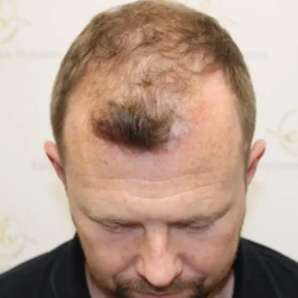 Before hair restoration
