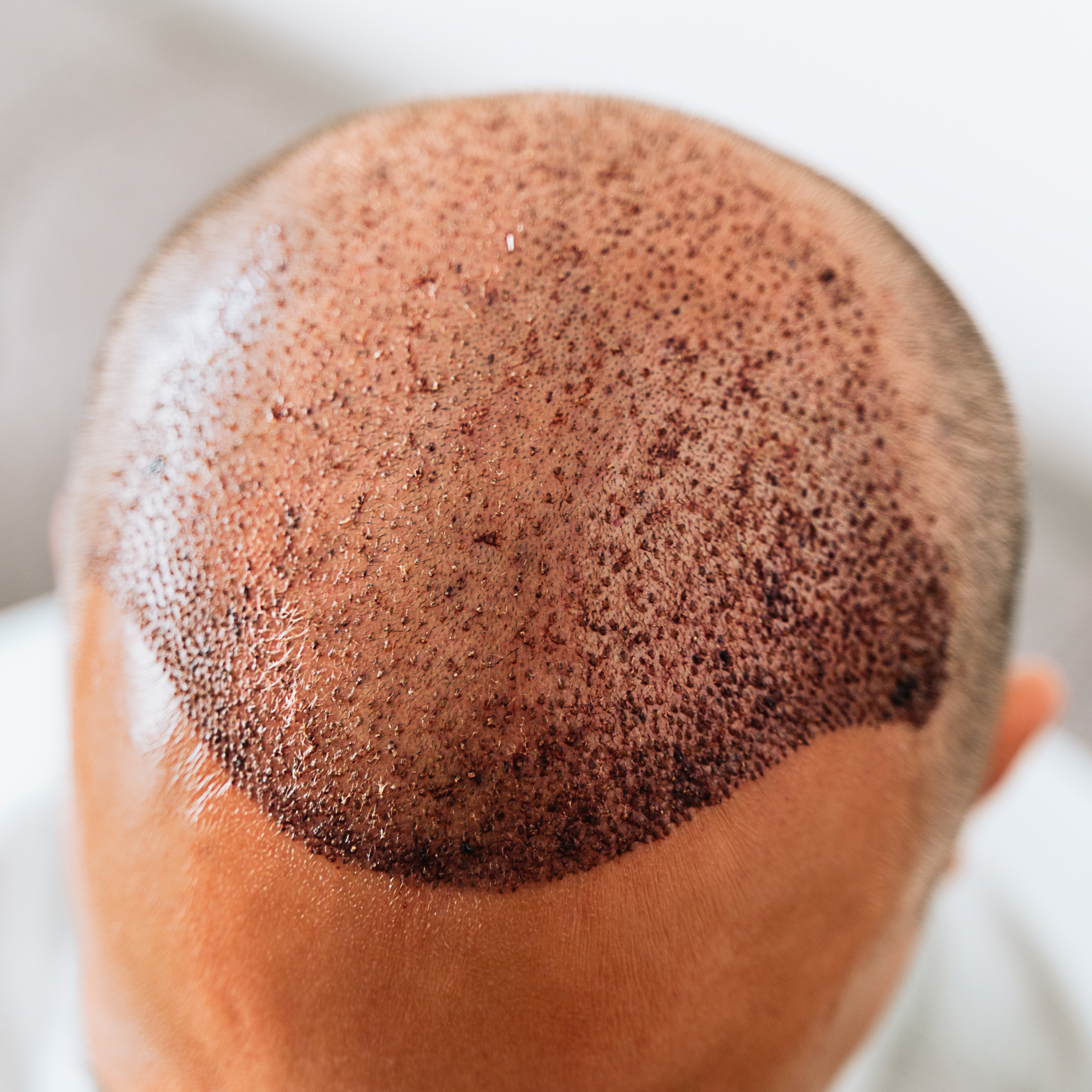 The first few days after your hair transplant