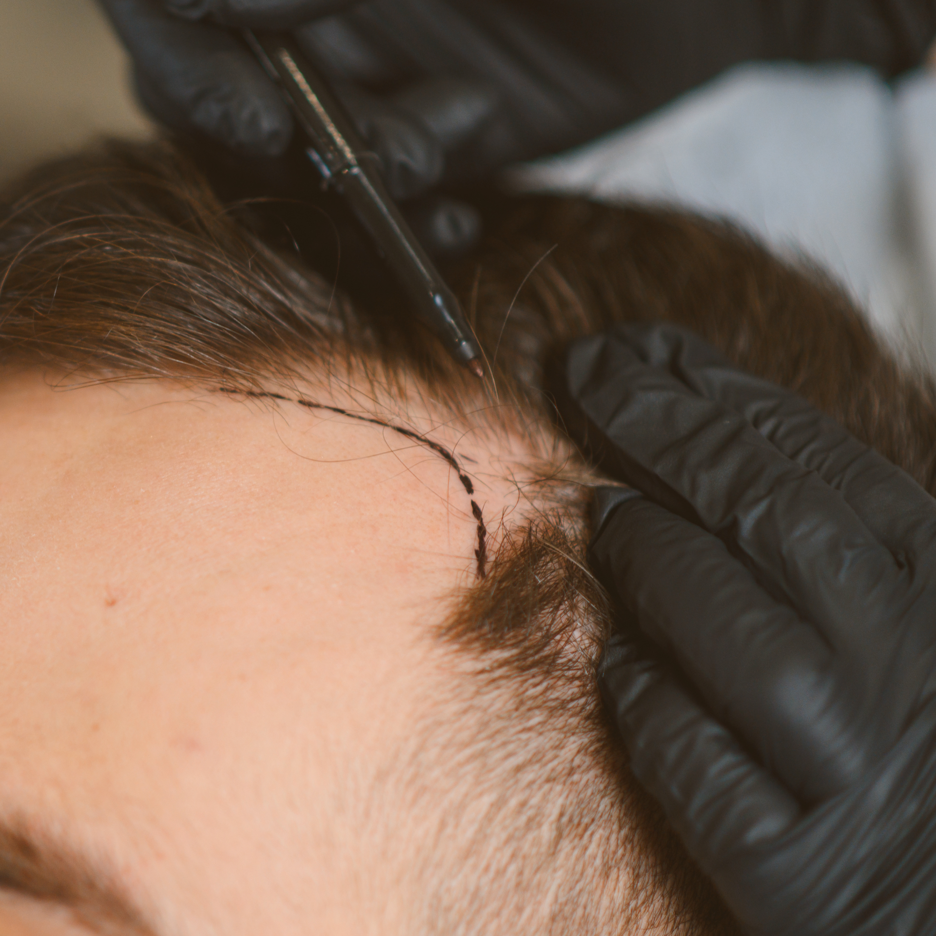 General recovery guidance after a hair transplant