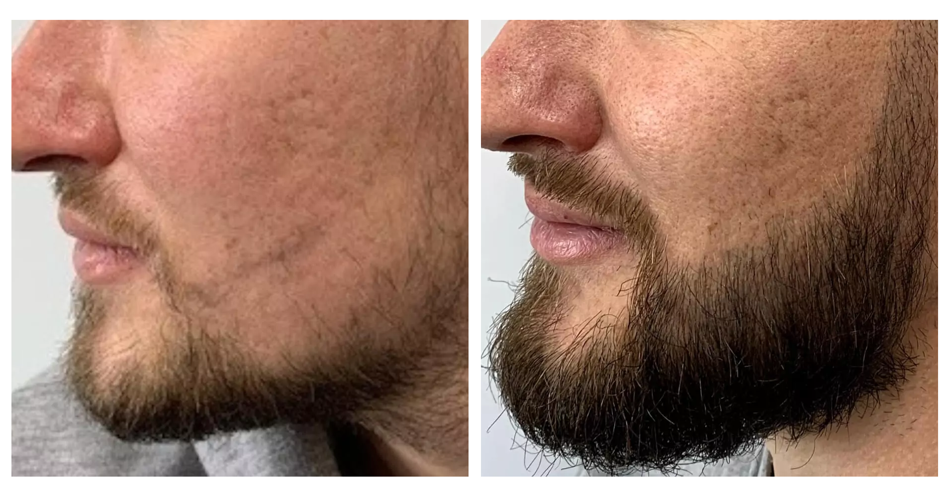 Beard<br>Restoration