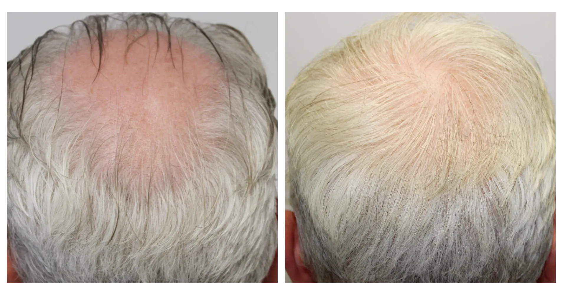Crown Hair<br>Transplant
