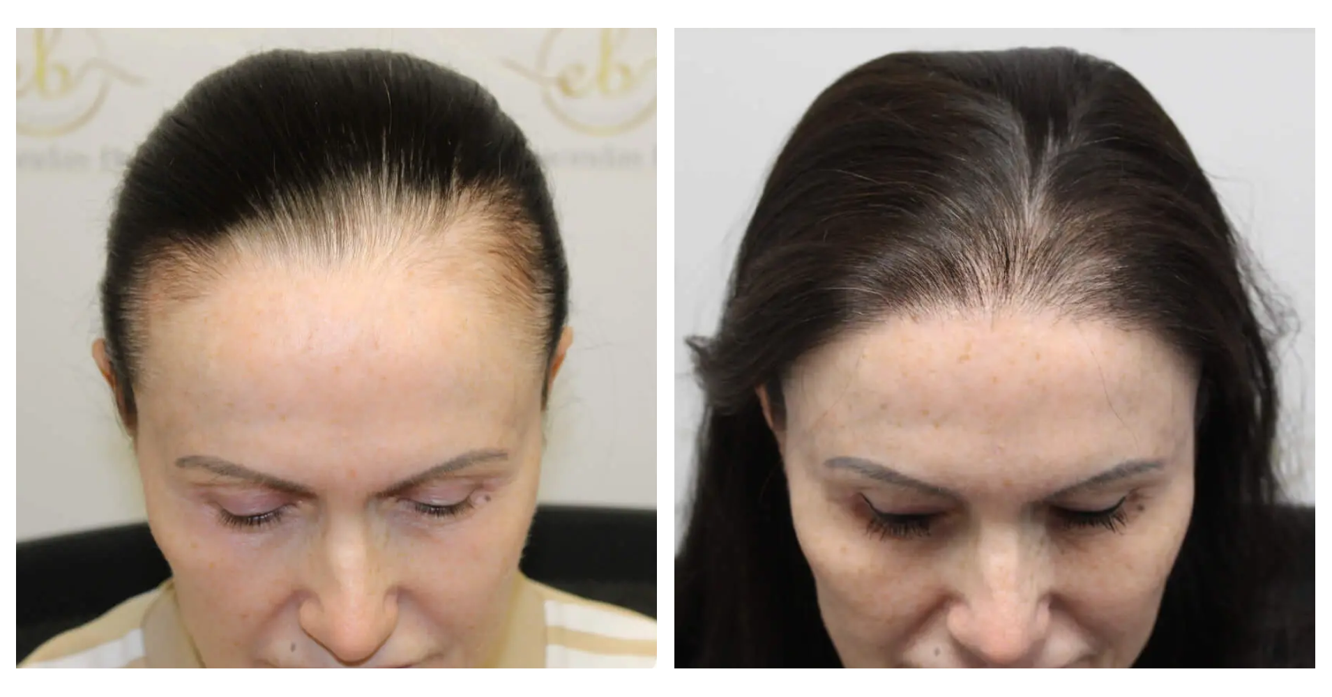 Female Hair<br>Transplant