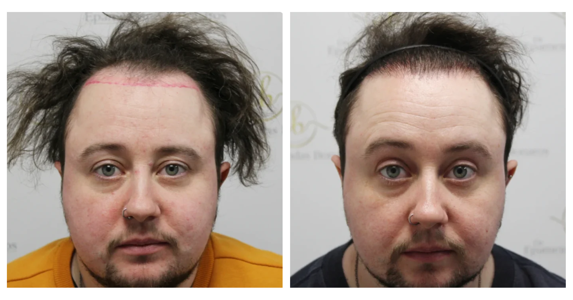 FtM Hair<br>Transplant