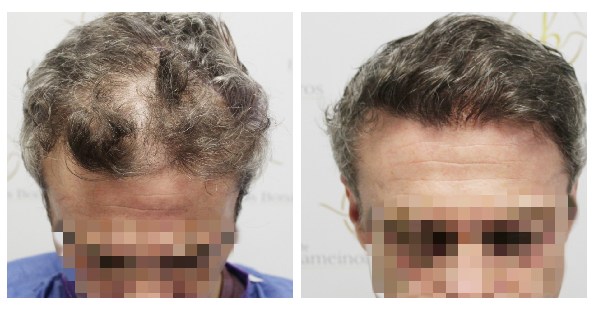 FUE Hair<br>Transplant