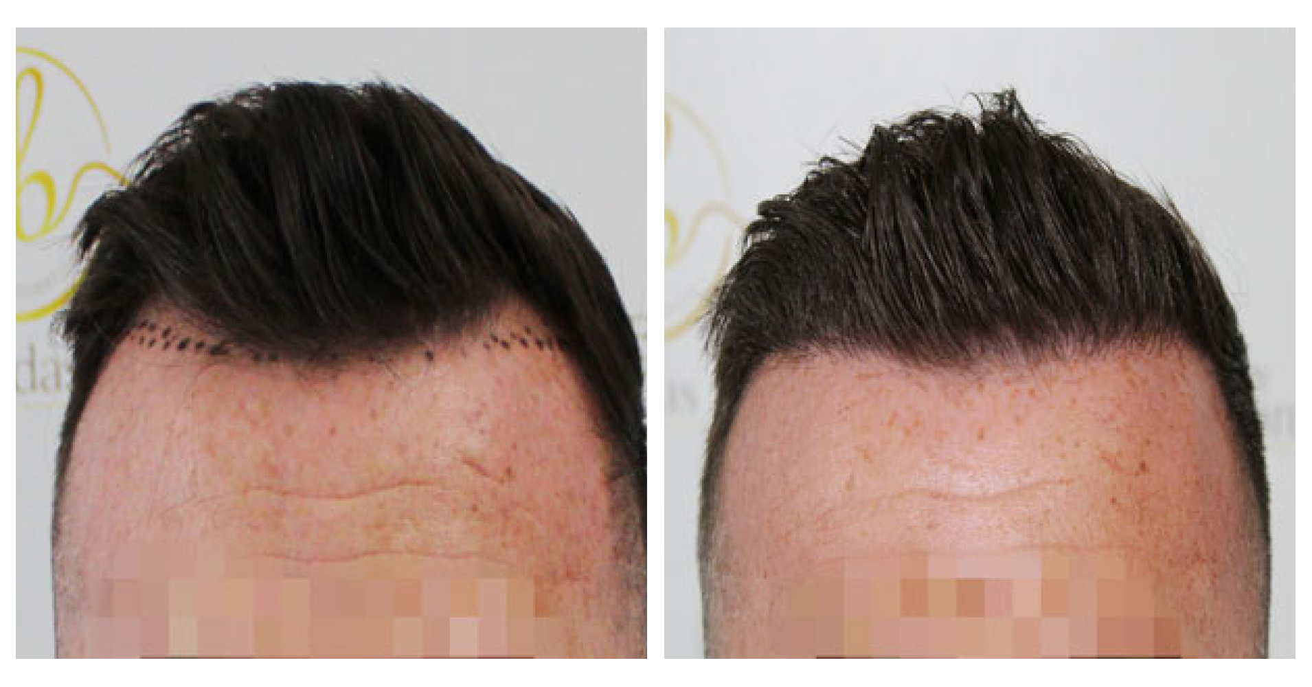 Hairline<br>Transplant