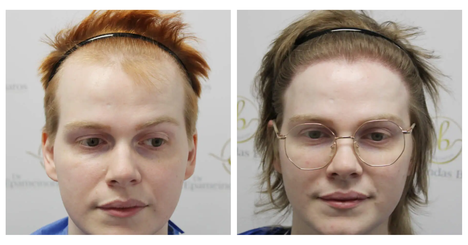 MtF Hair<br>Transplant