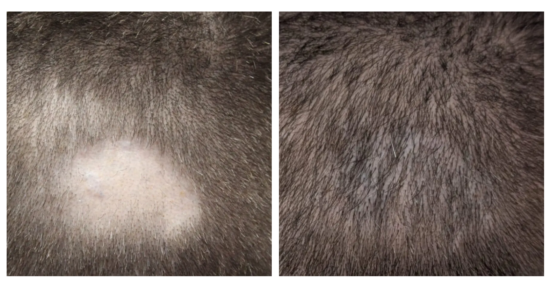 Scar Repair<br>Hair Transplant