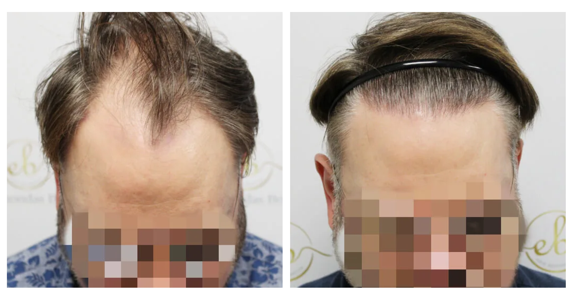 Unshaven FUE<br>Hair Transplant