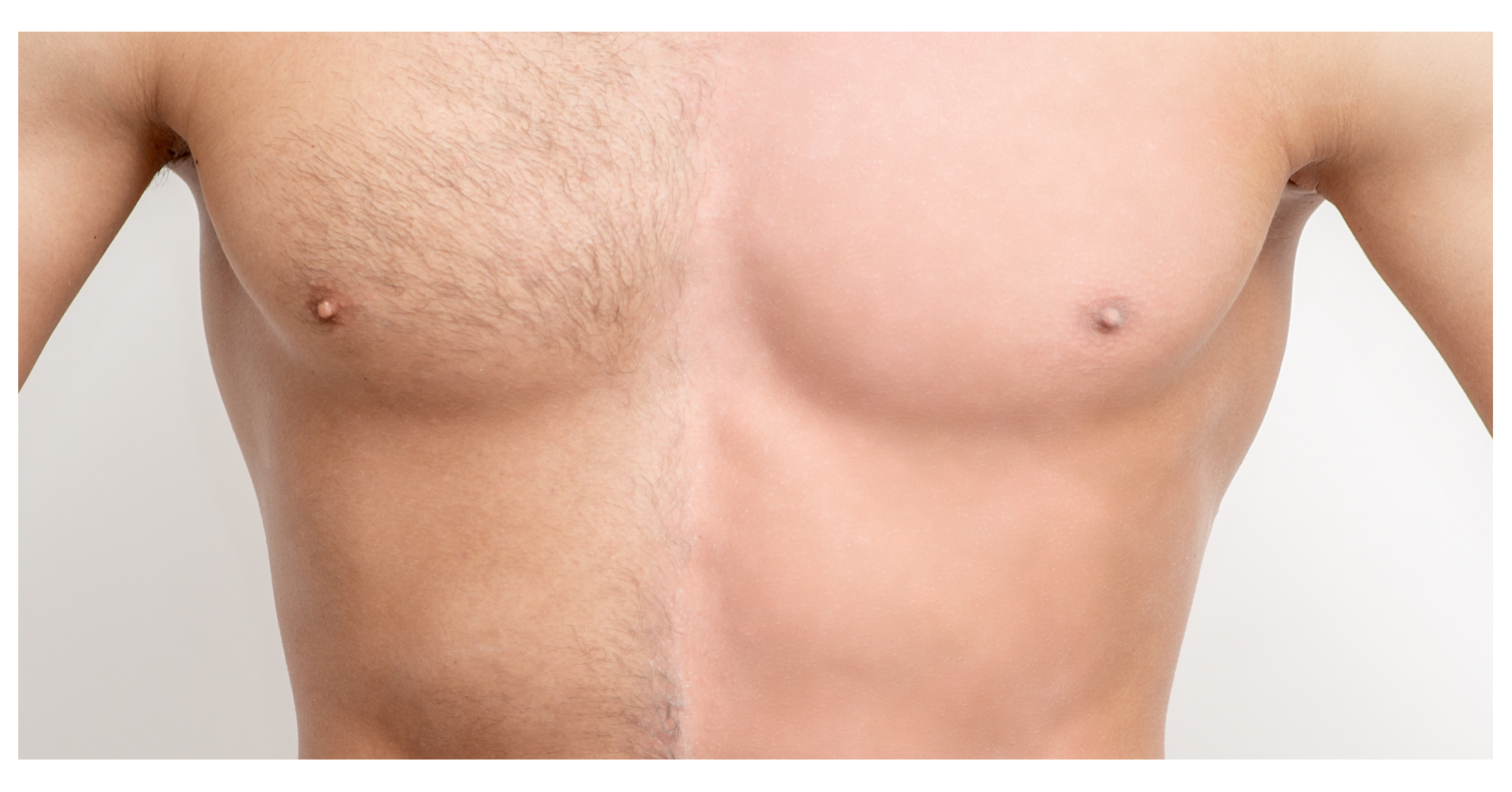 Body Hair<br>Transplant