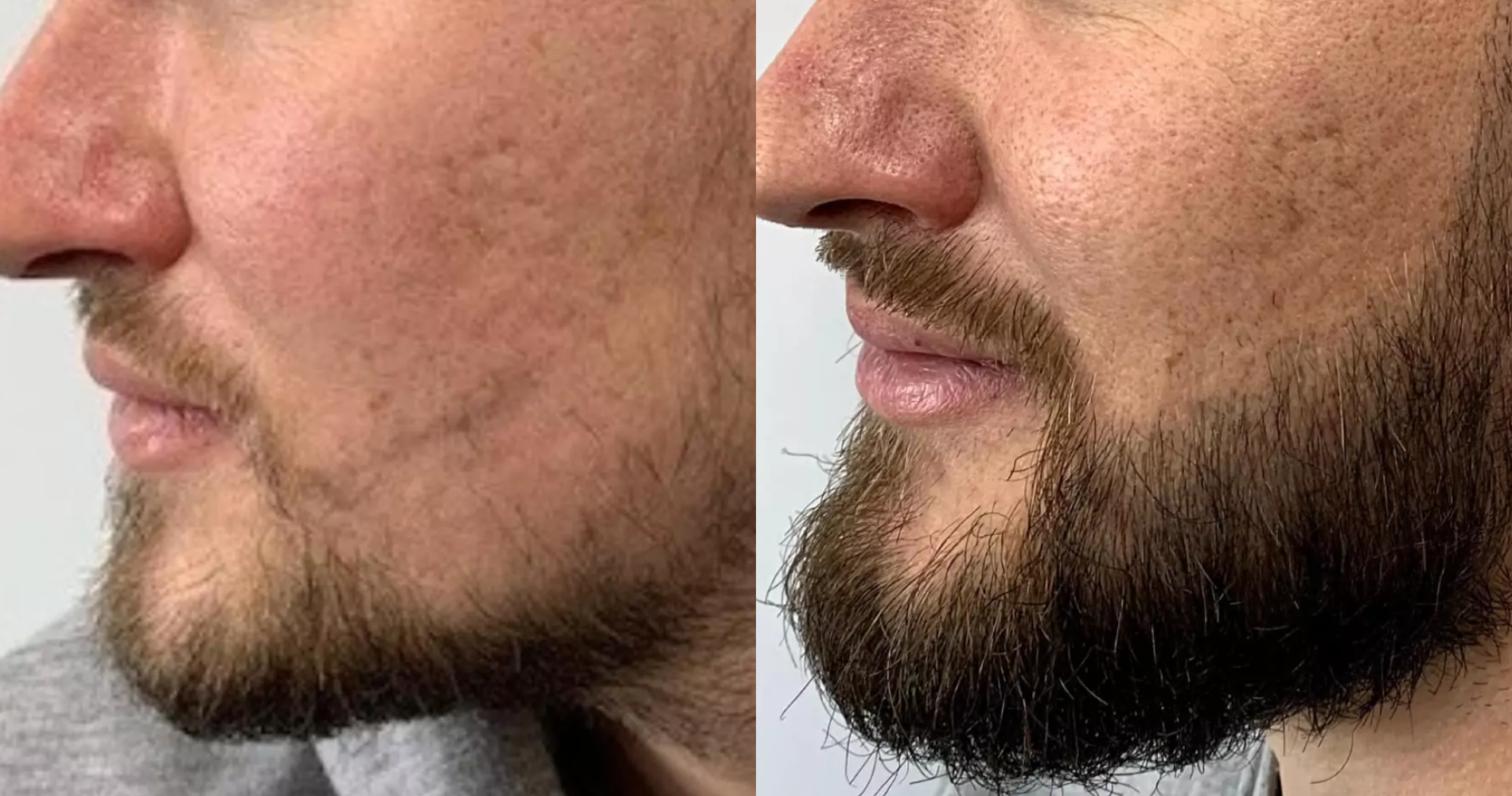 Beard<br>Restoration