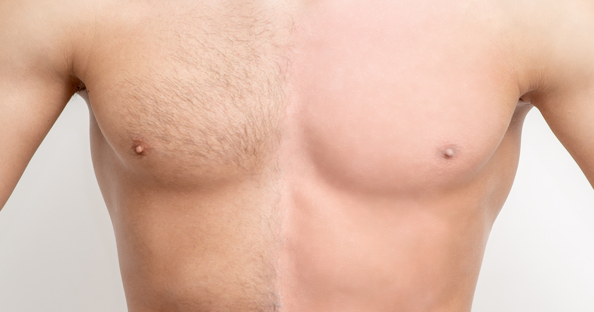 Body Hair<br>Transplant