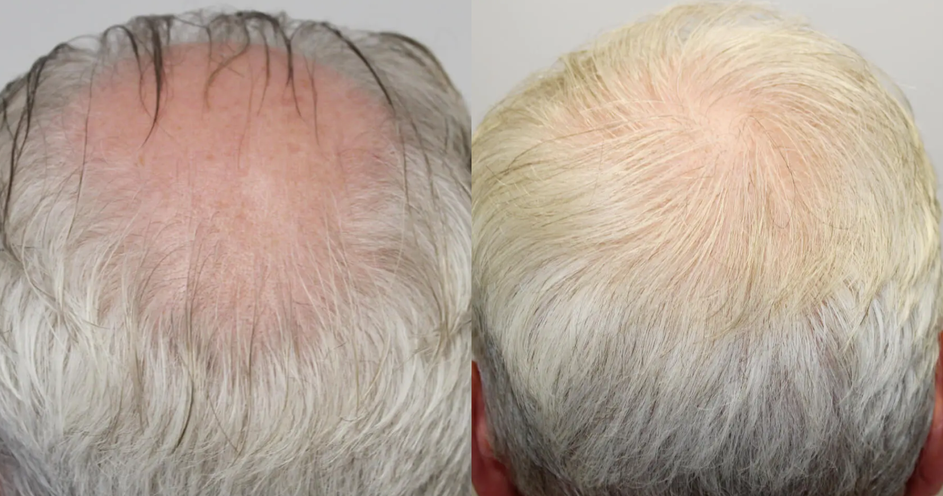 Crown Hair<br>Transplant