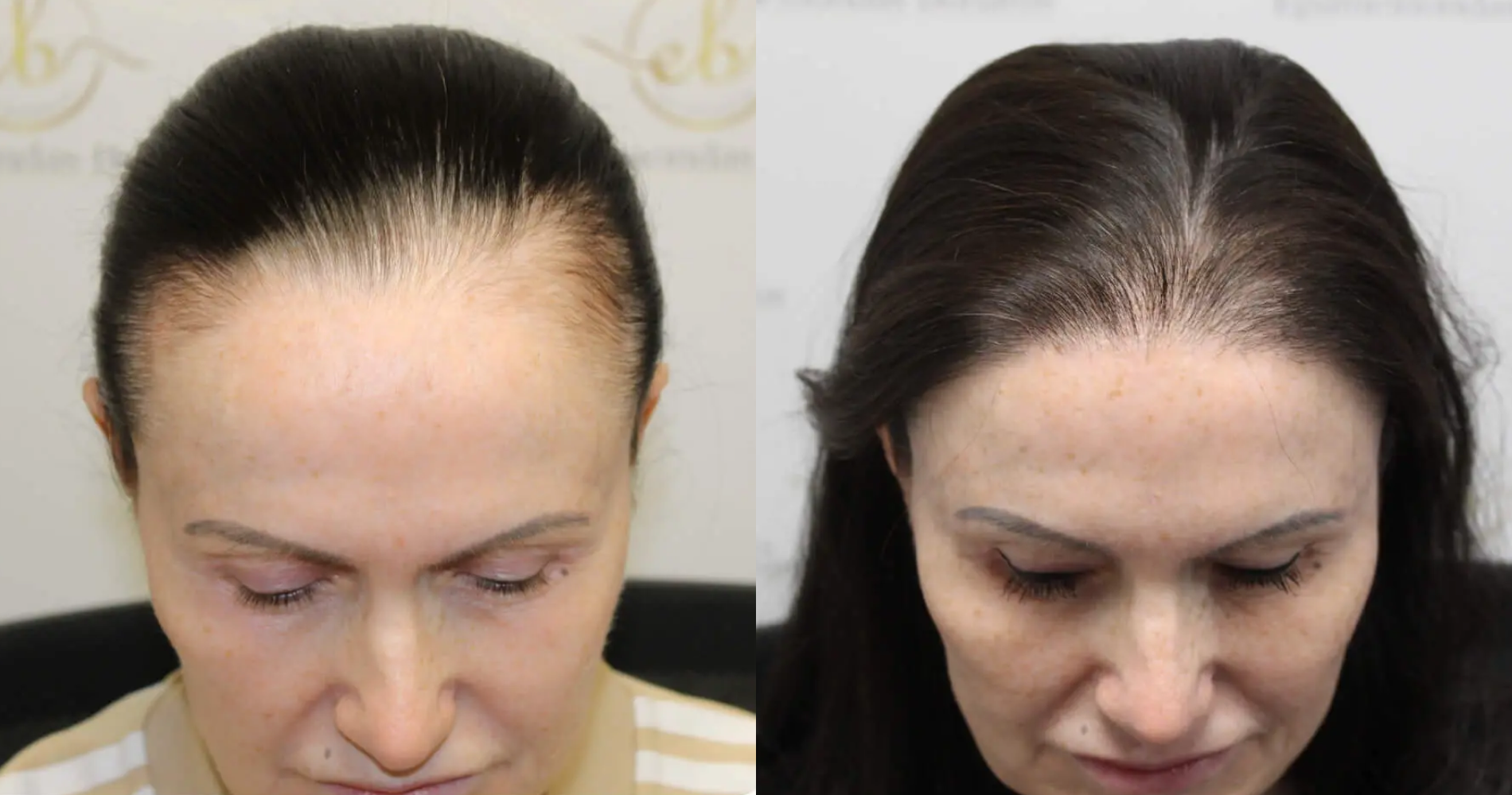 Female Hair<br>Transplant