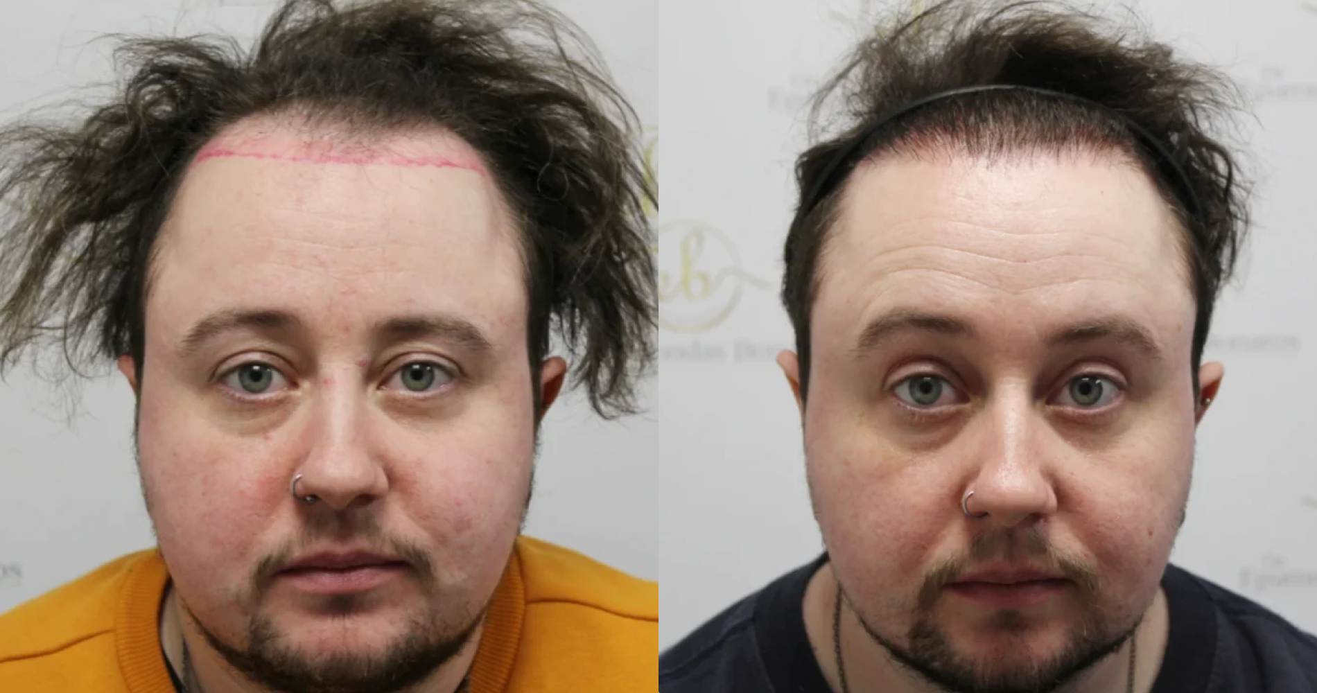 FtM Hair<br>Transplant
