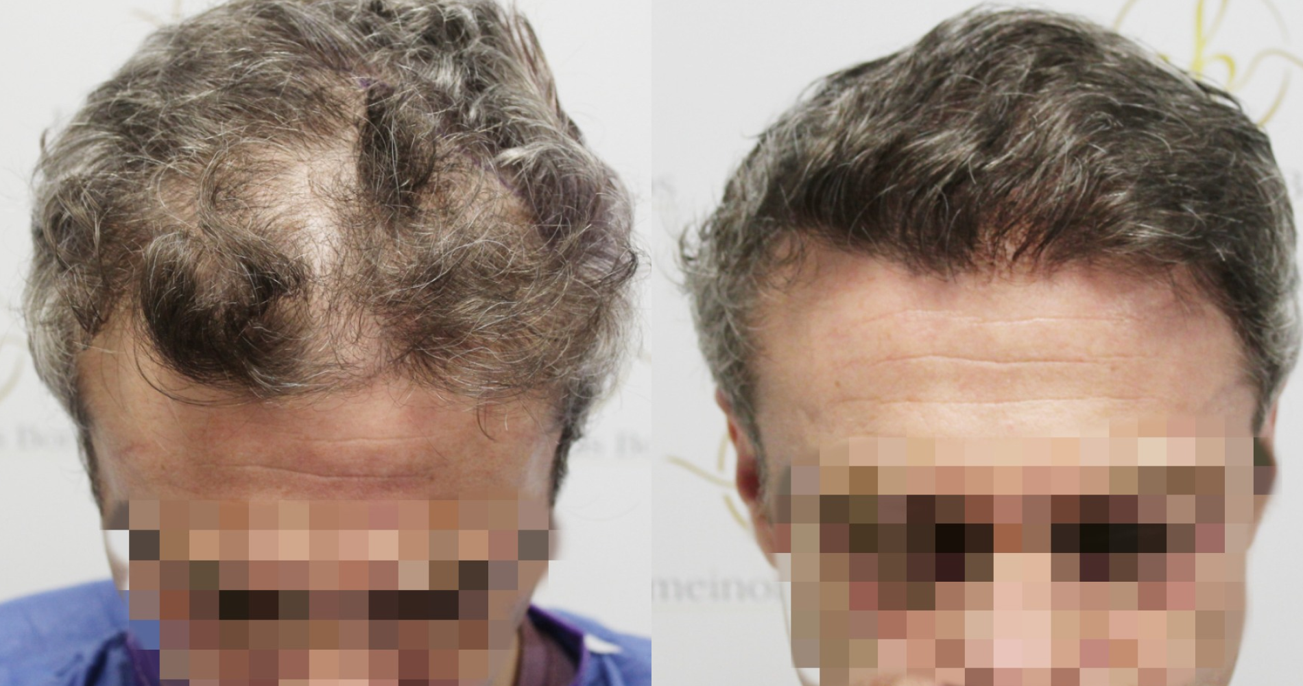 FUE Hair<br>Transplant