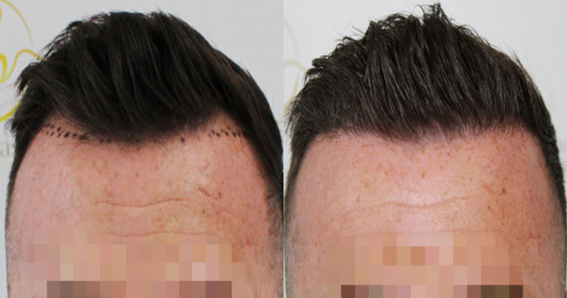 Hairline<br>Transplant