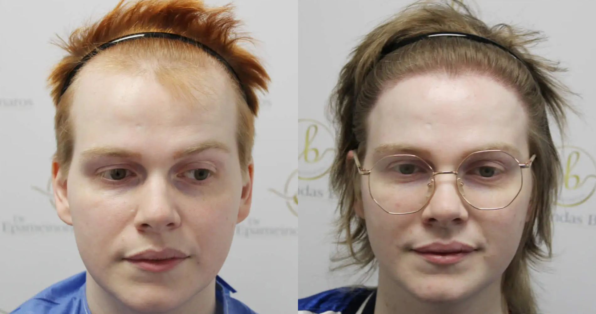 MtF Hair<br>Transplant
