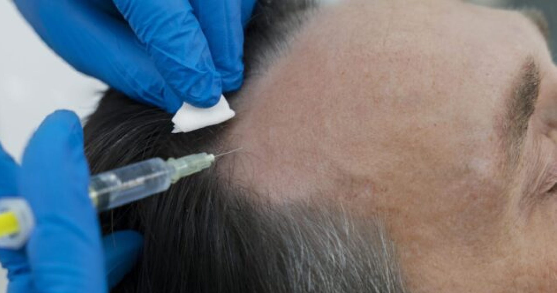 Non-Surgical<br>Hair Treatment