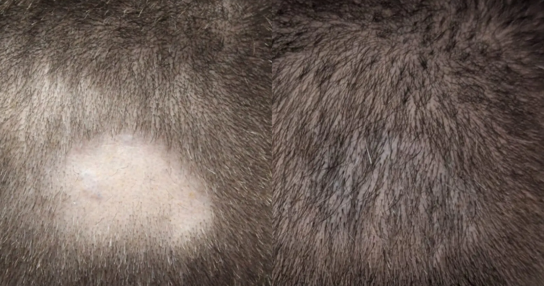 Scar Repair<br>Hair Transplant